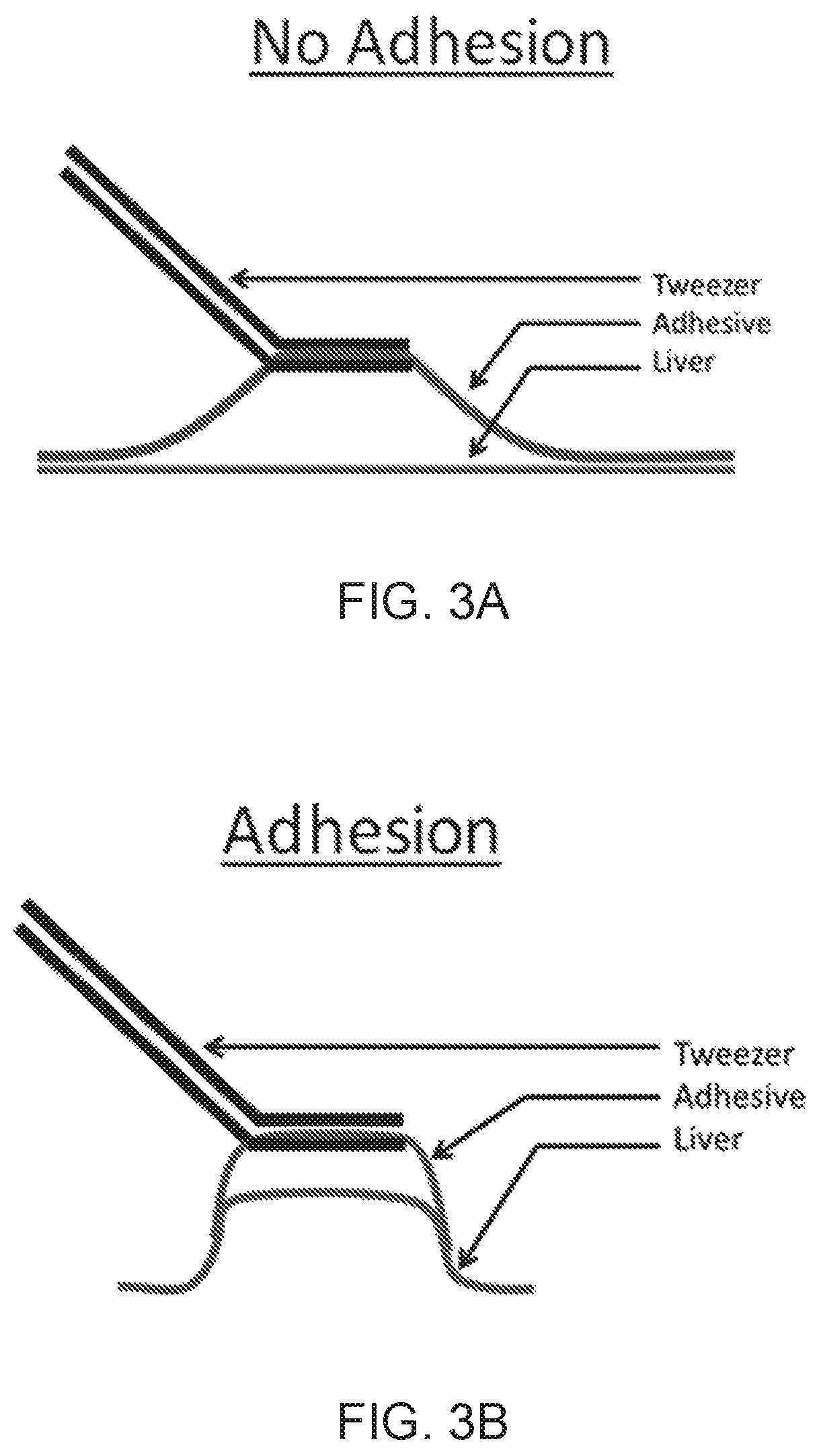 Patent US12090244 Figure 3 – Surgical adhesive able to glue in wet conditions