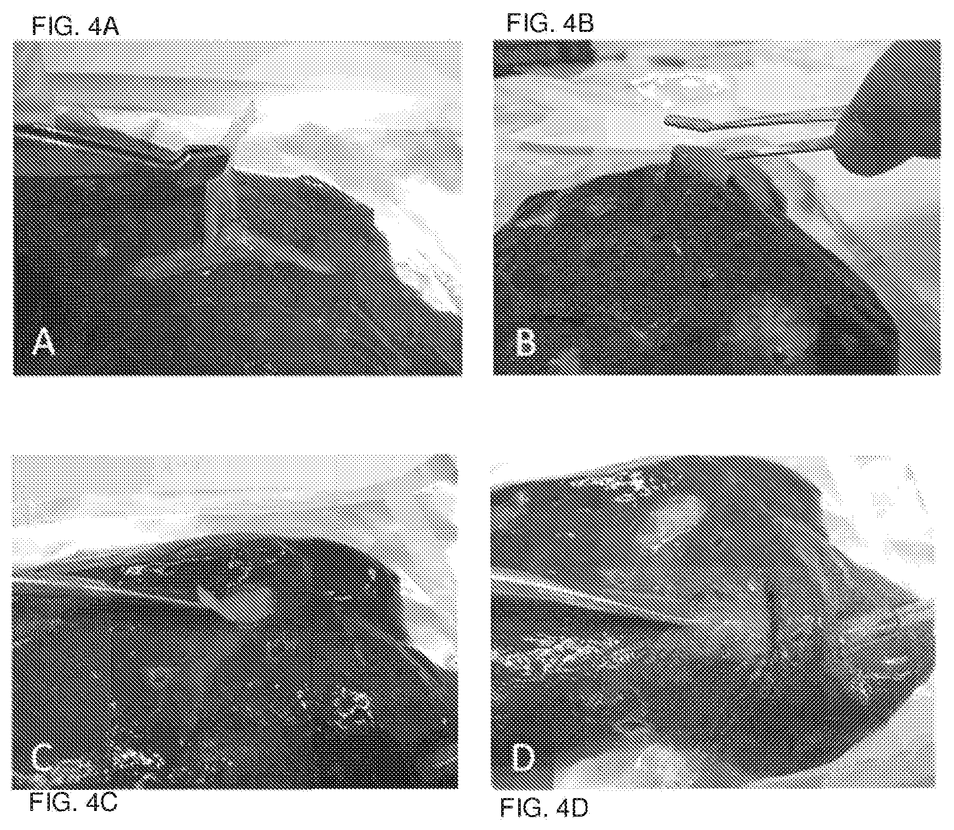 Patent US12090244 Figure 4 – Surgical adhesive able to glue in wet conditions