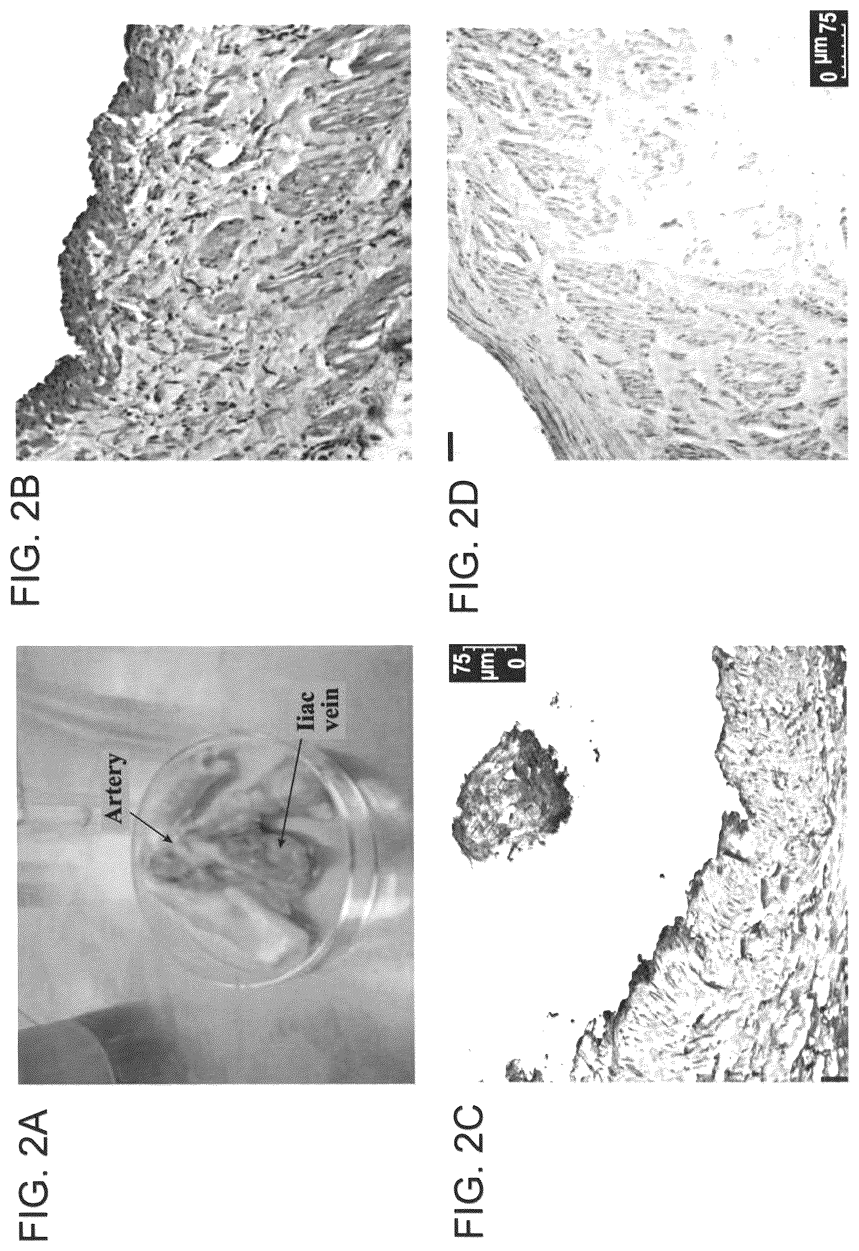 Patent US12090253 Figure 3 – Bioengineered allogeneic blood vessel