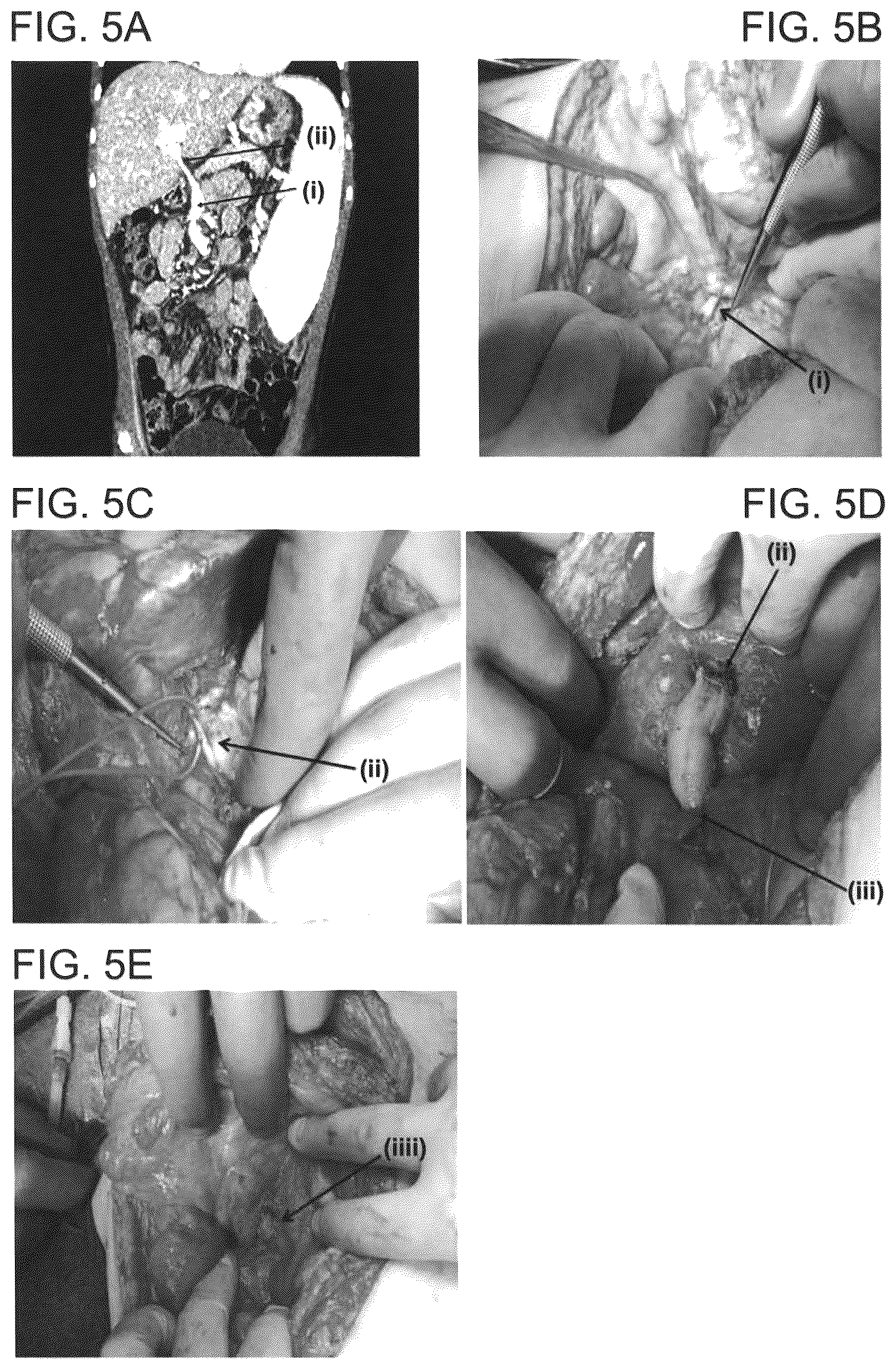 Patent US12090253 Figure 10 – Bioengineered allogeneic blood vessel