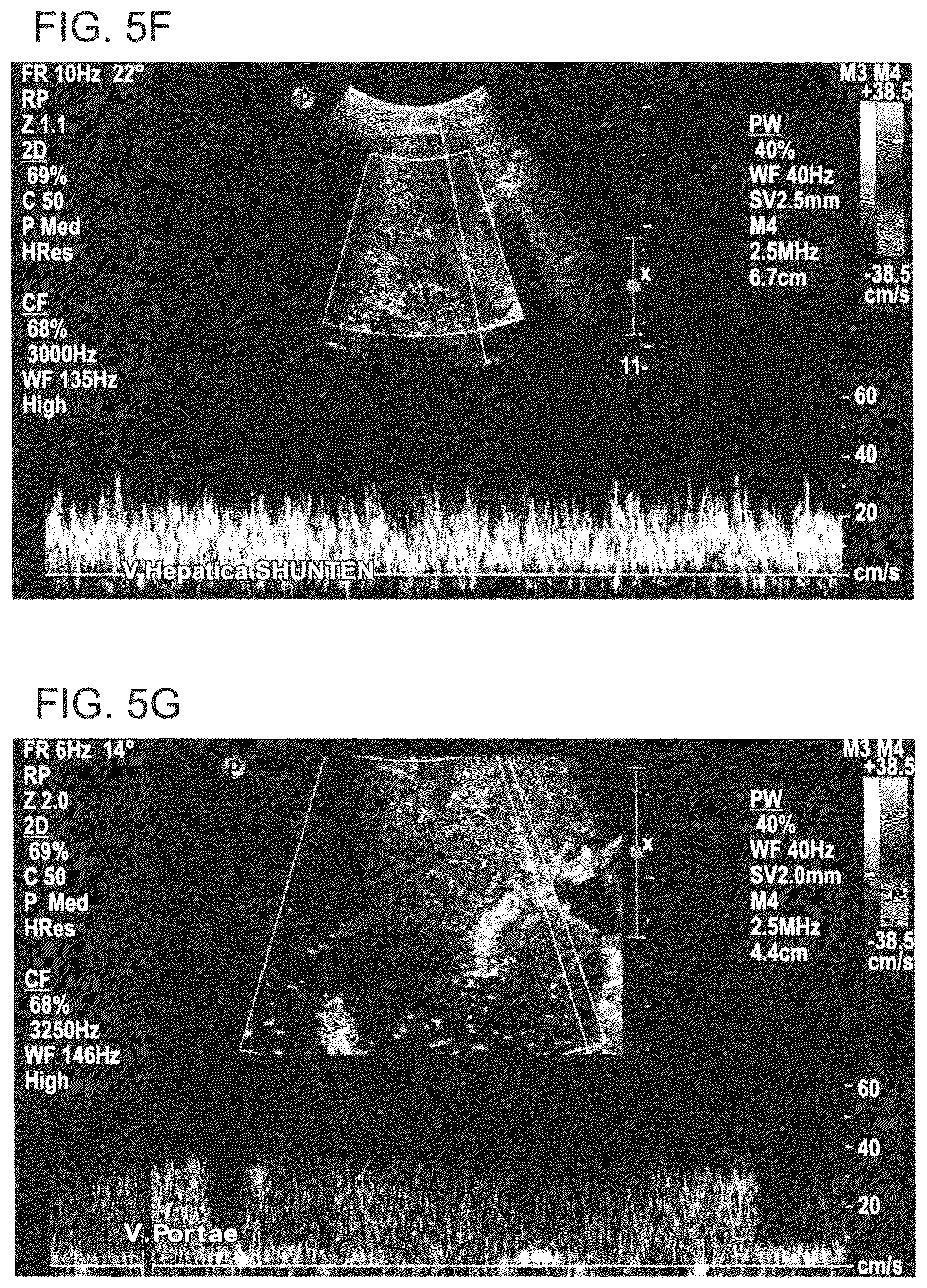 Patent US12090253 Figure 11 – Bioengineered allogeneic blood vessel