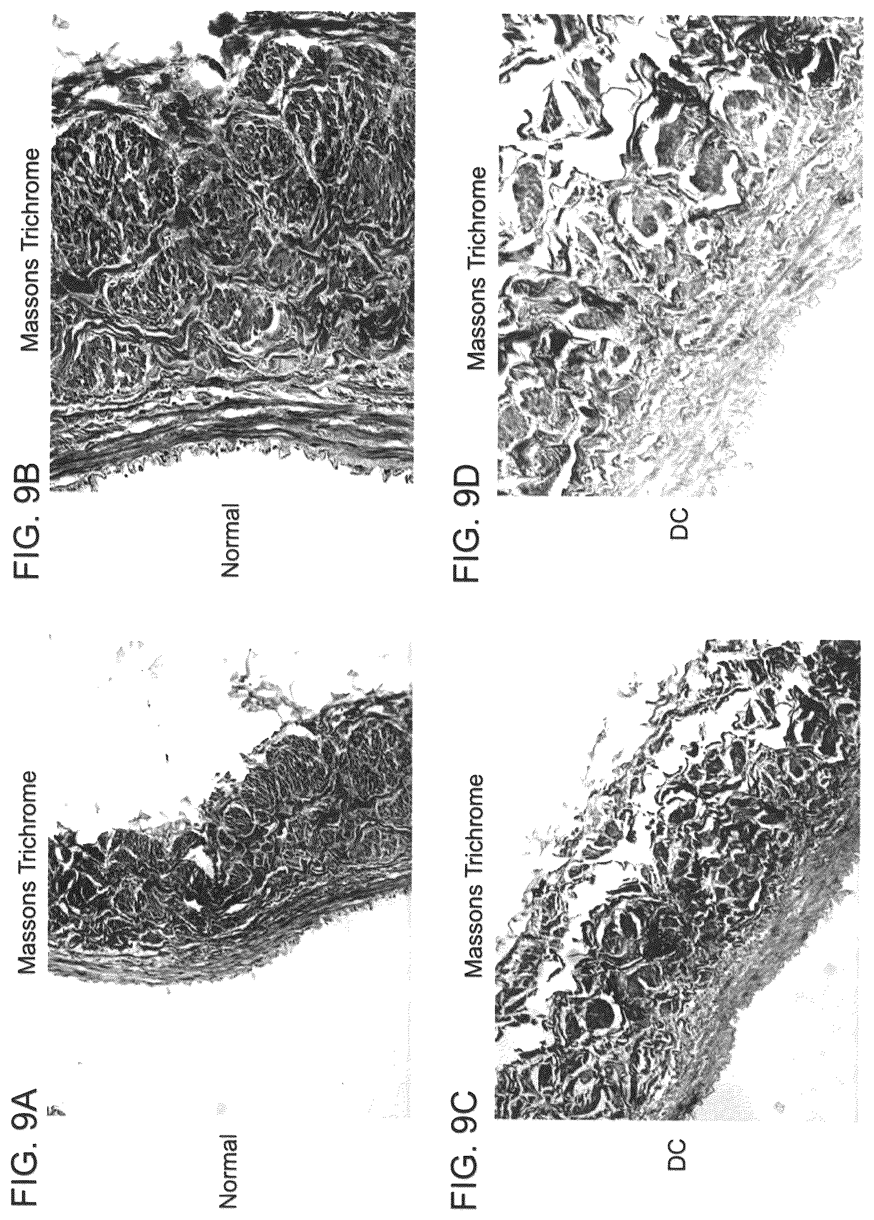 Patent US12090253 Figure 16 – Bioengineered allogeneic blood vessel