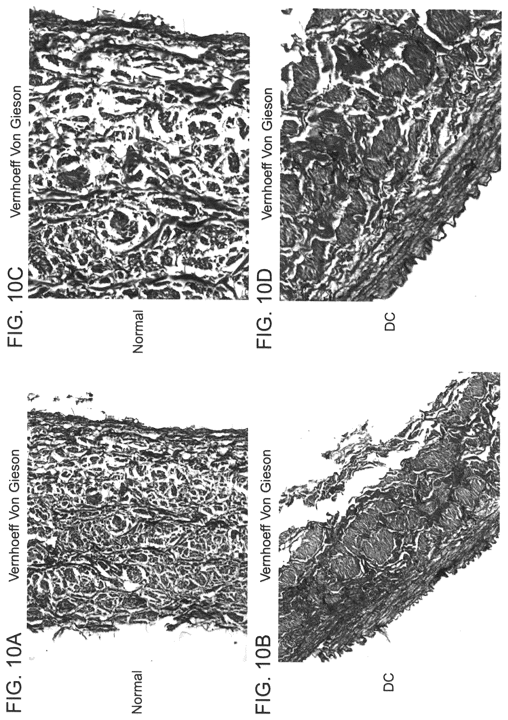 Patent US12090253 Figure 17 – Bioengineered allogeneic blood vessel