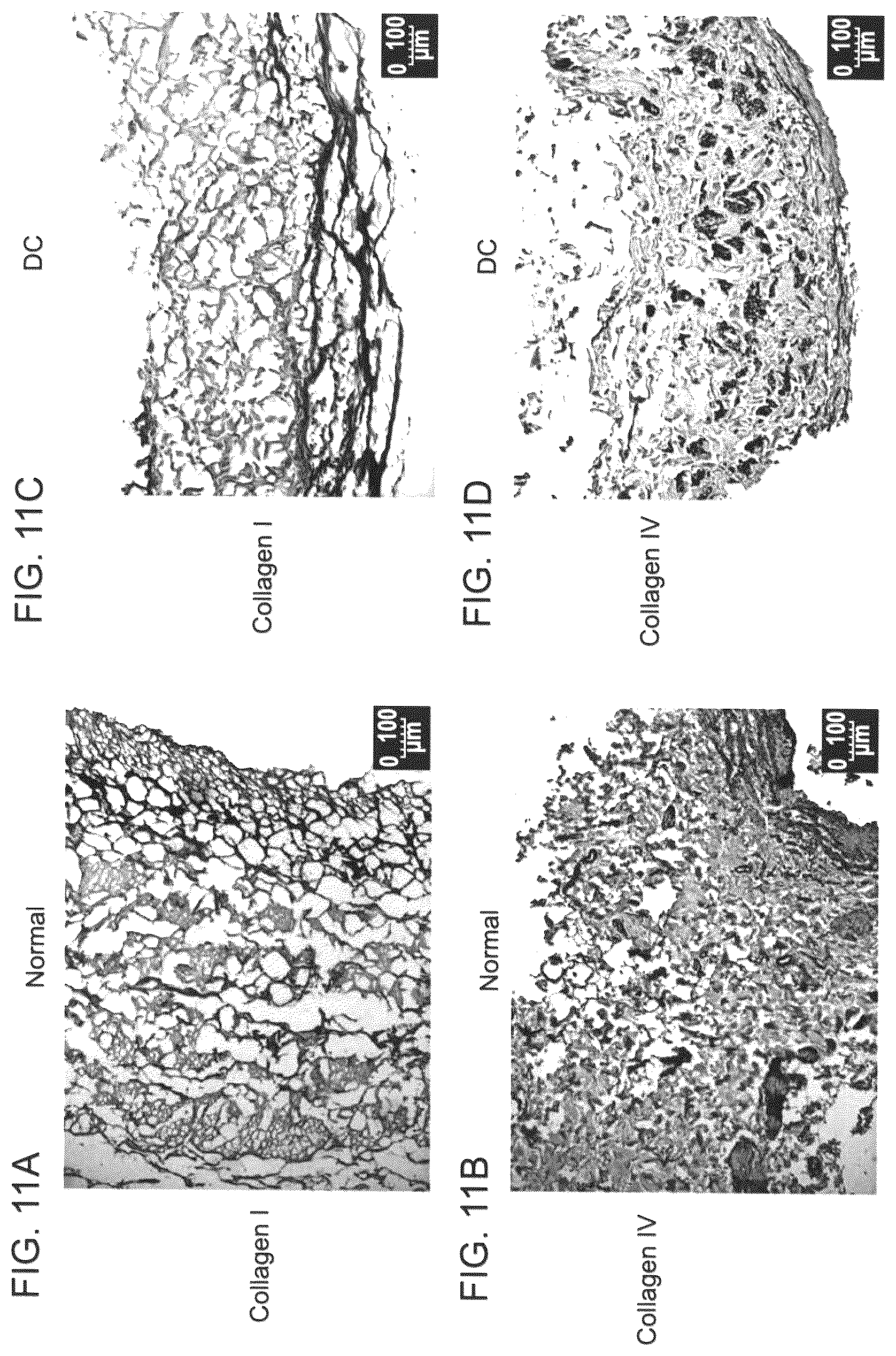 Patent US12090253 Figure 18 – Bioengineered allogeneic blood vessel