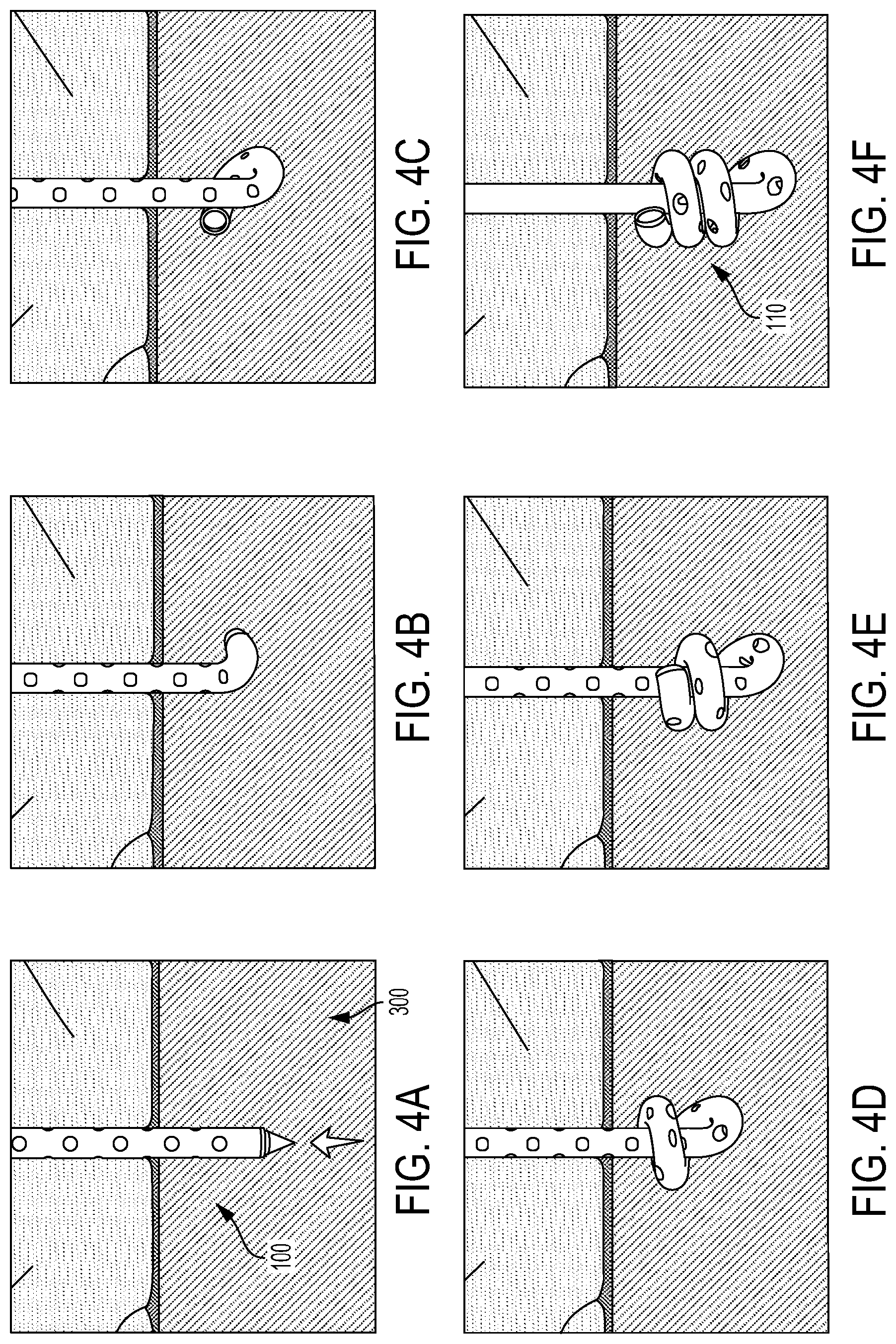 Patent US12090260 Figure 4 – Drainage or infusion catheter and method of use