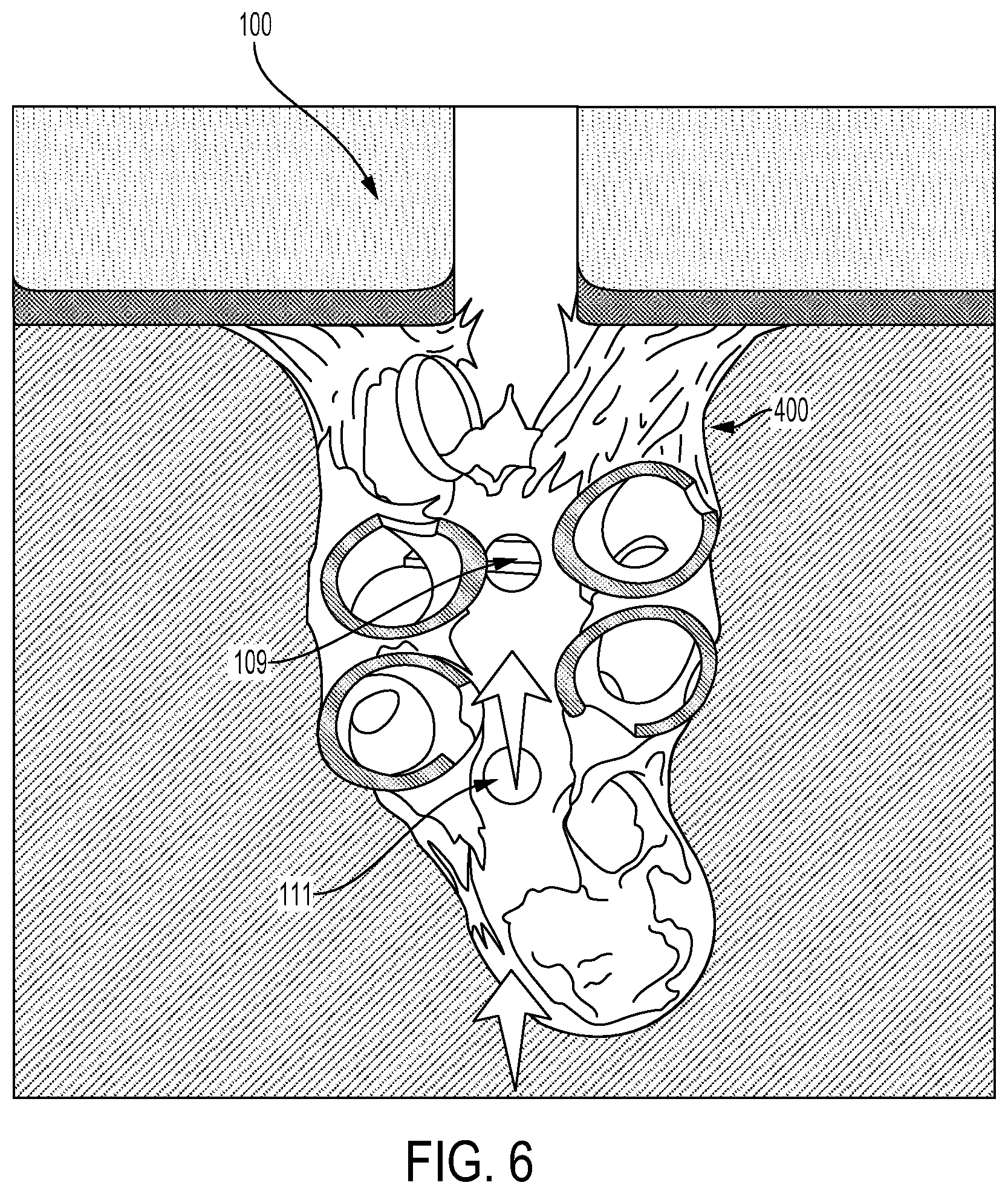 Patent US12090260 Figure 6 – Drainage or infusion catheter and method of use