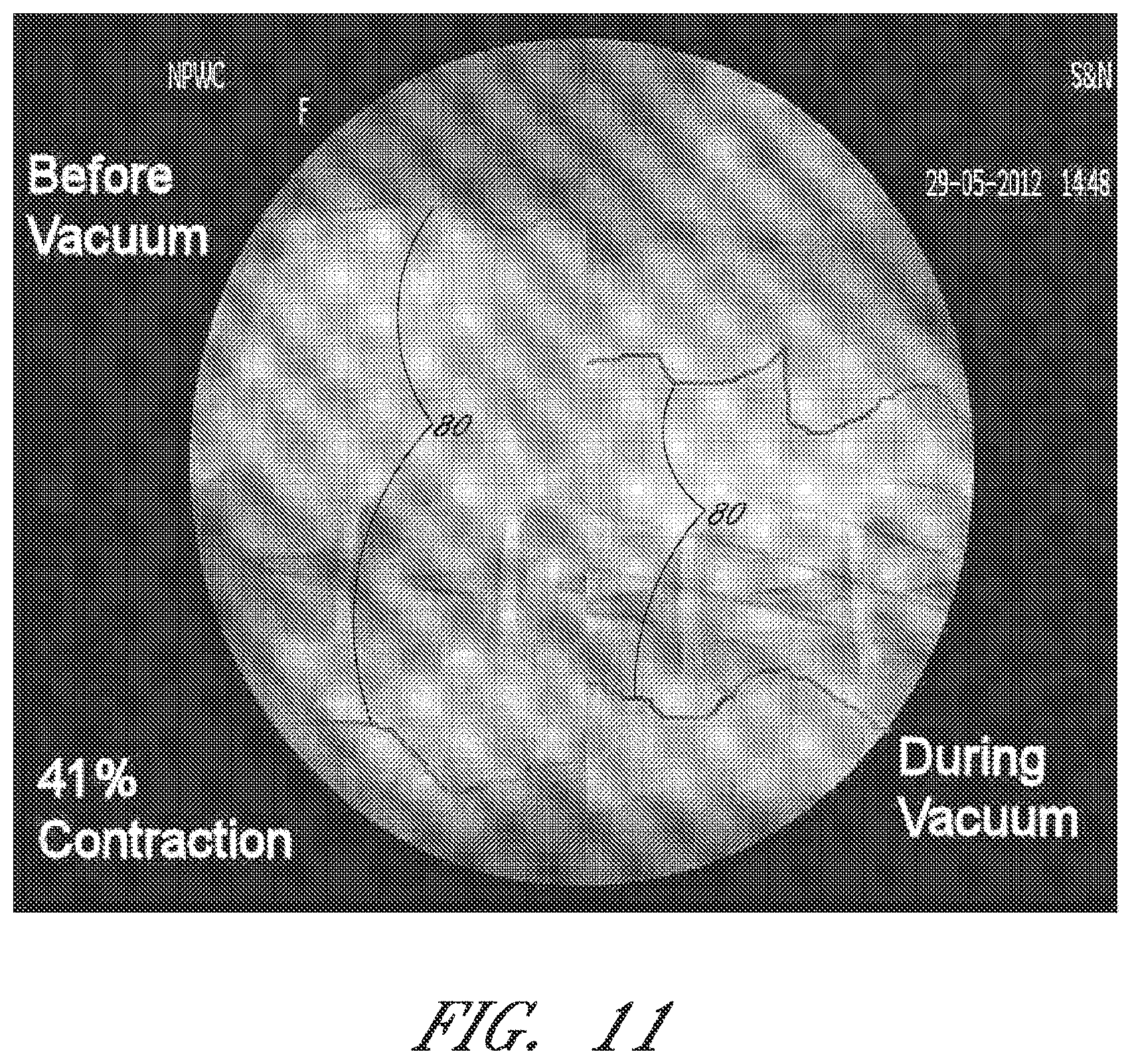 Patent US12090264 Figure 11 – Apparatuses and methods for wound therapy