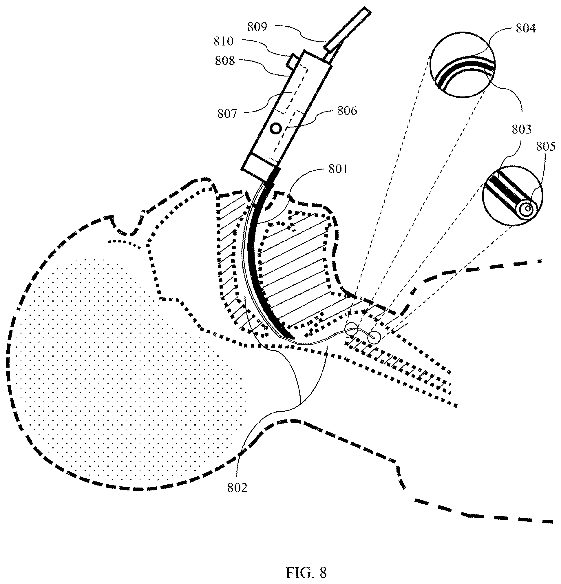 Patent US12090273 Figure 8 – System and method for automated intubation