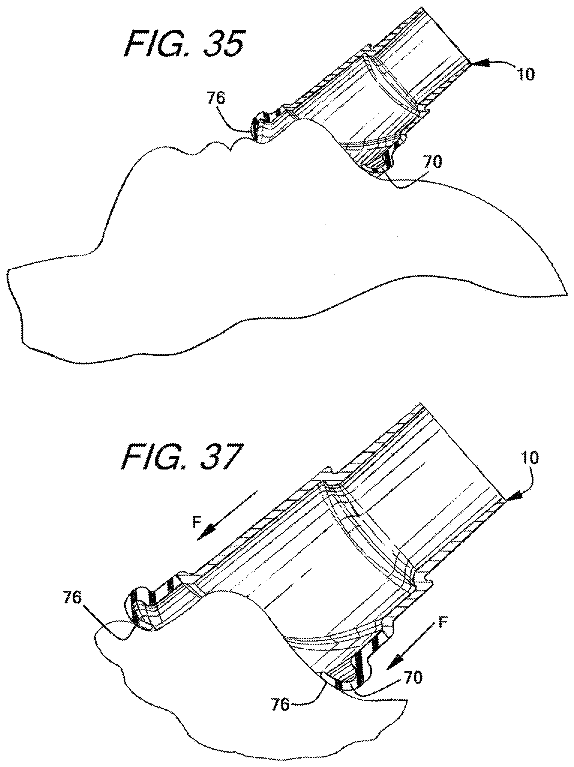 Patent US12090274 Figure 20 – Nasal ventilation mask