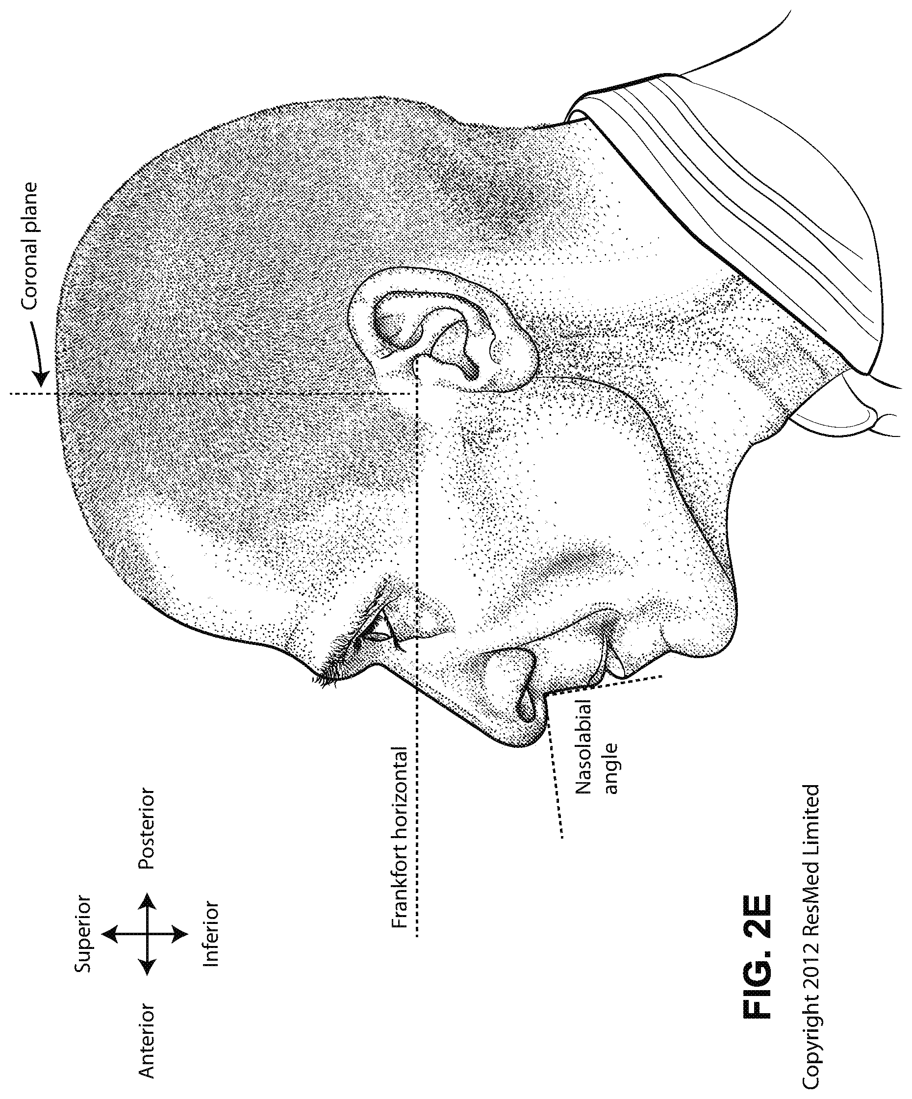 Patent US12090275 Figure 8 – Patient interface