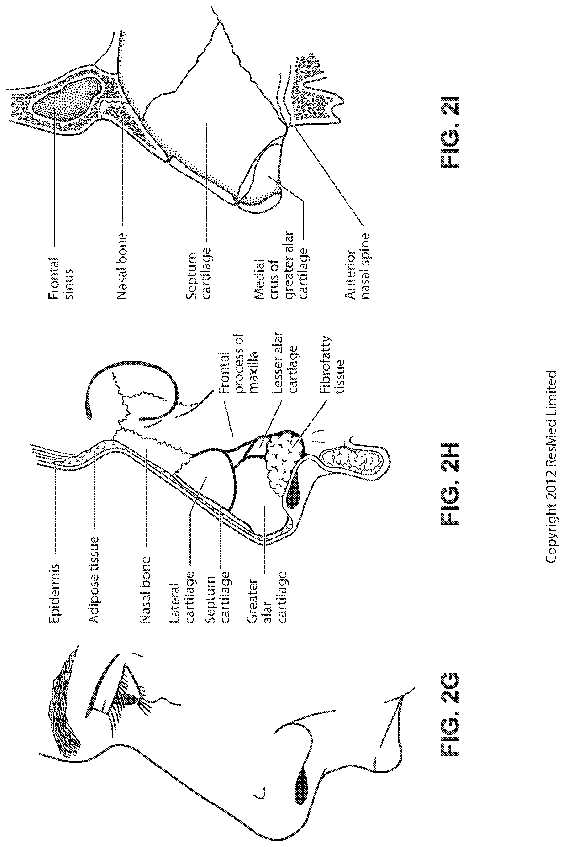 Patent US12090275 Figure 10 – Patient interface