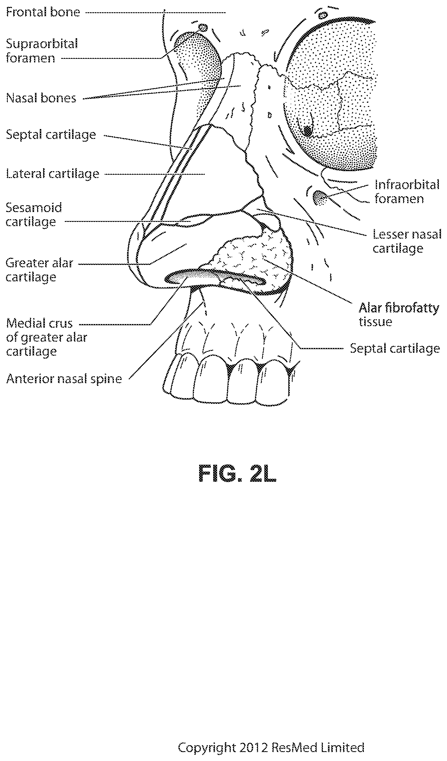 Patent US12090275 Figure 12 – Patient interface