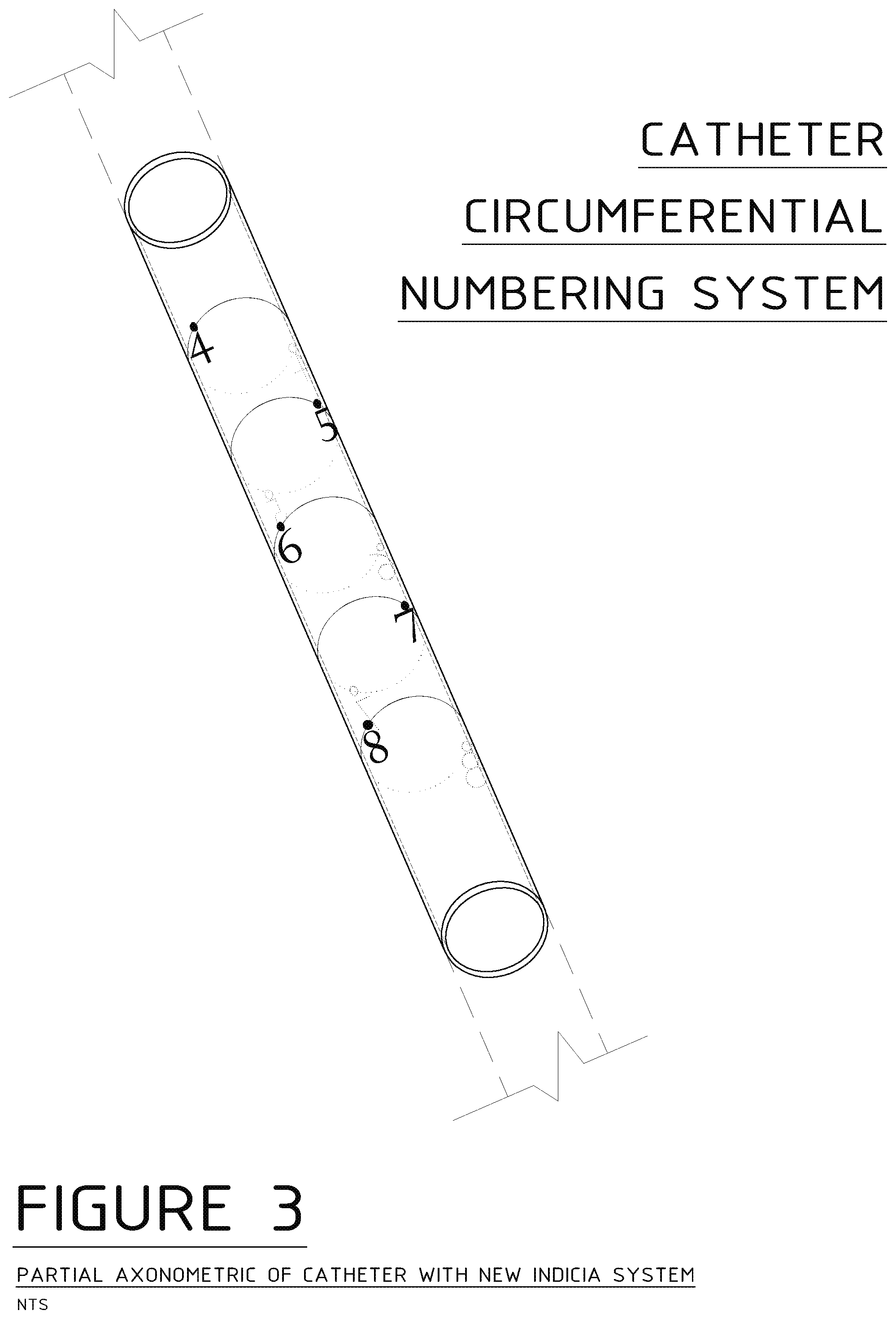 Patent US12090281 Figure 3 – Circumferential numbering system for catheters and anchor drain