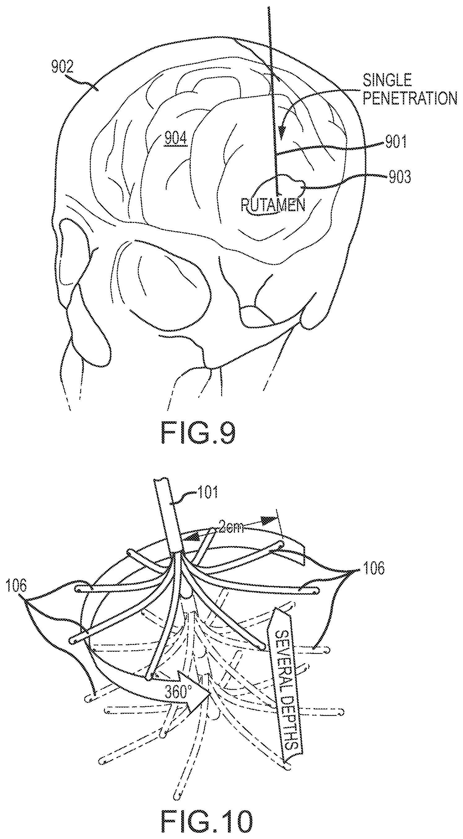Patent US12090283 Figure 7 – Microinjection catheter