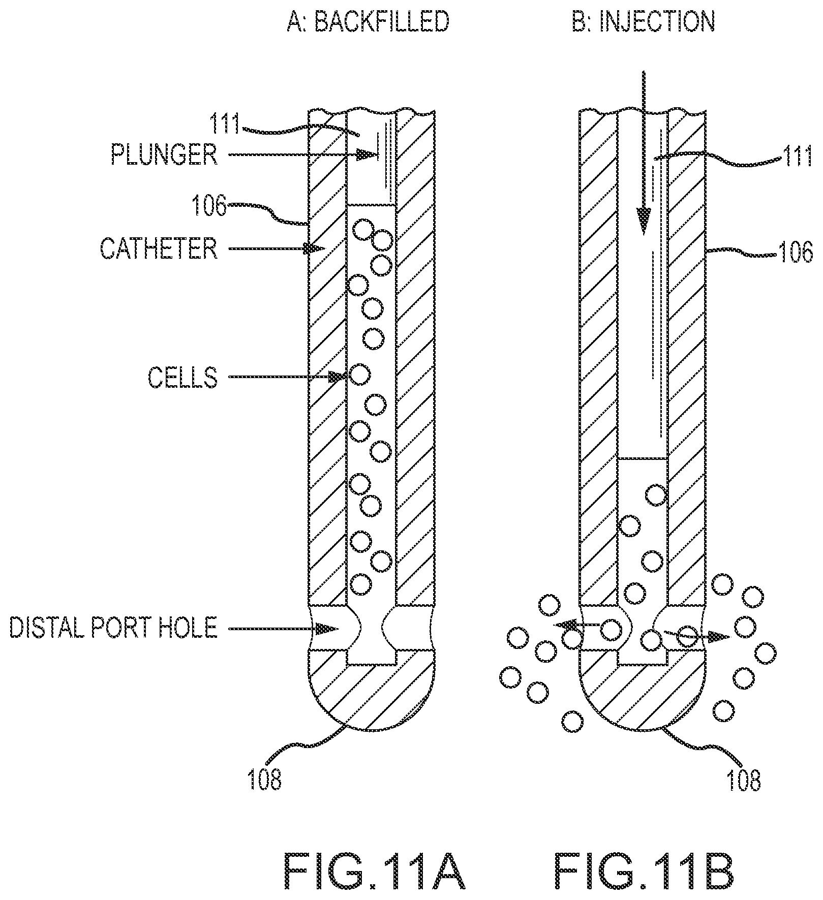 Patent US12090283 Figure 8 – Microinjection catheter