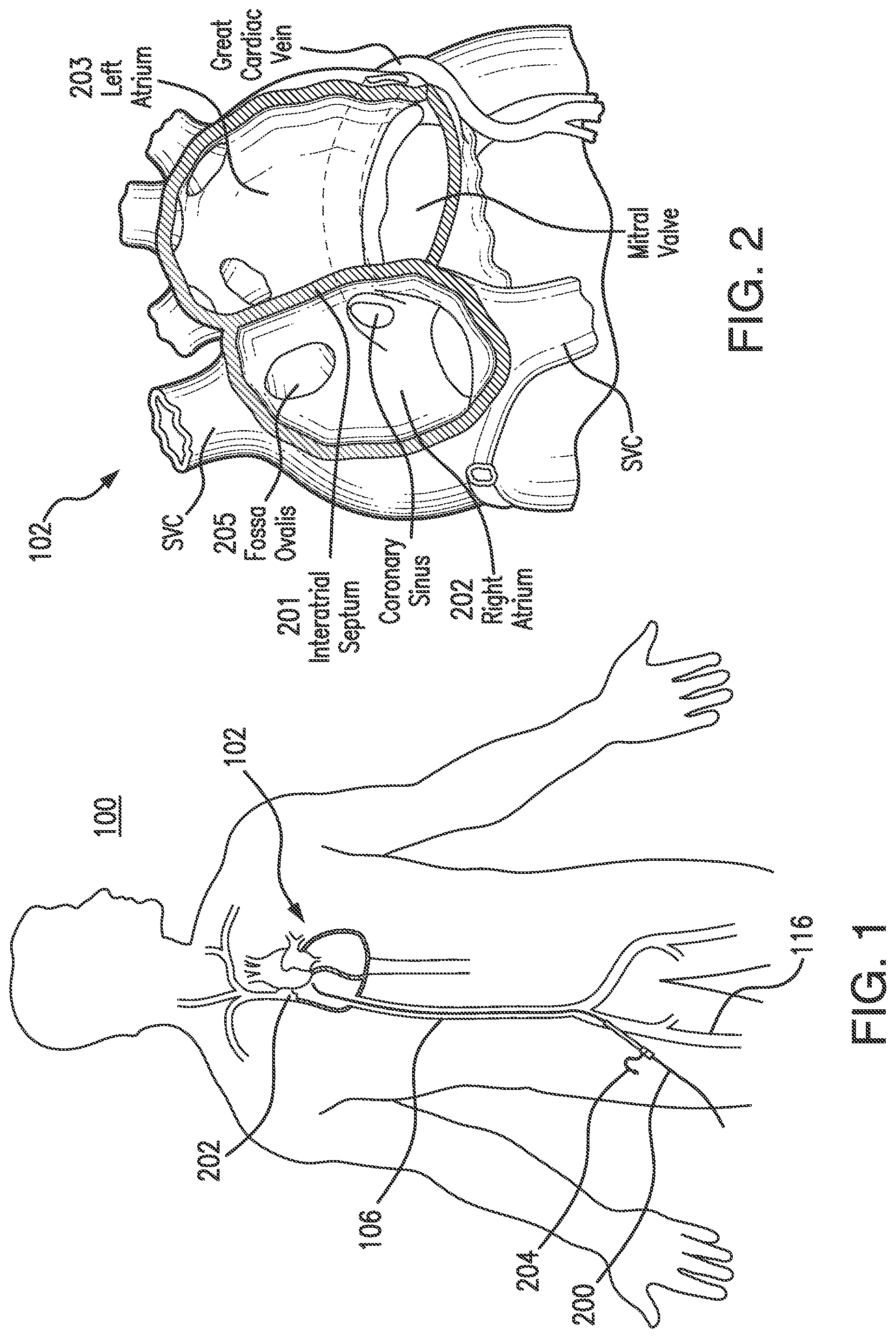 Patent US12090284 Figure 1 – Puncture devices, and systems and methods for accessing tissue