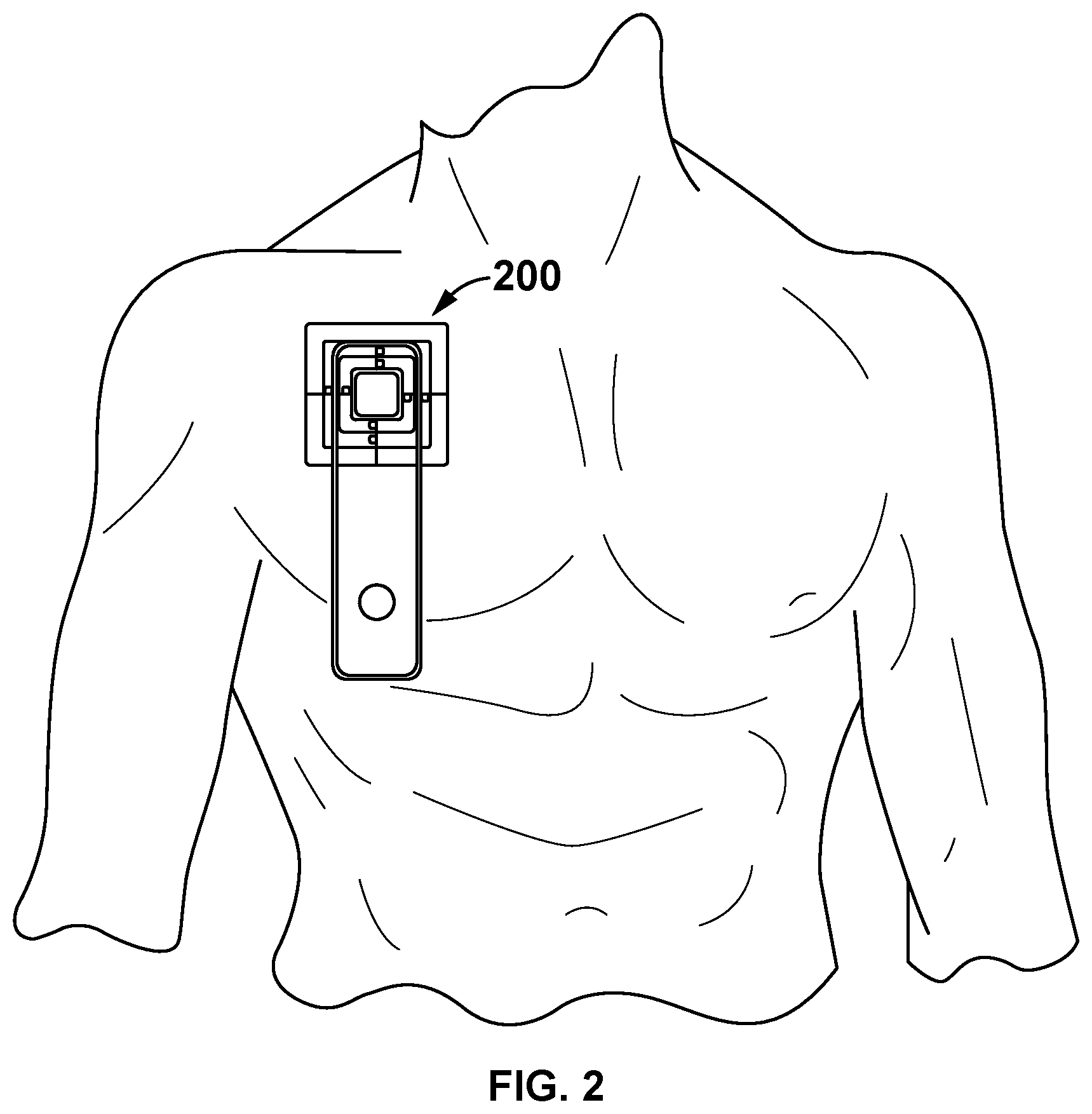 Patent US12090287 Figure 2 – Catheter shield