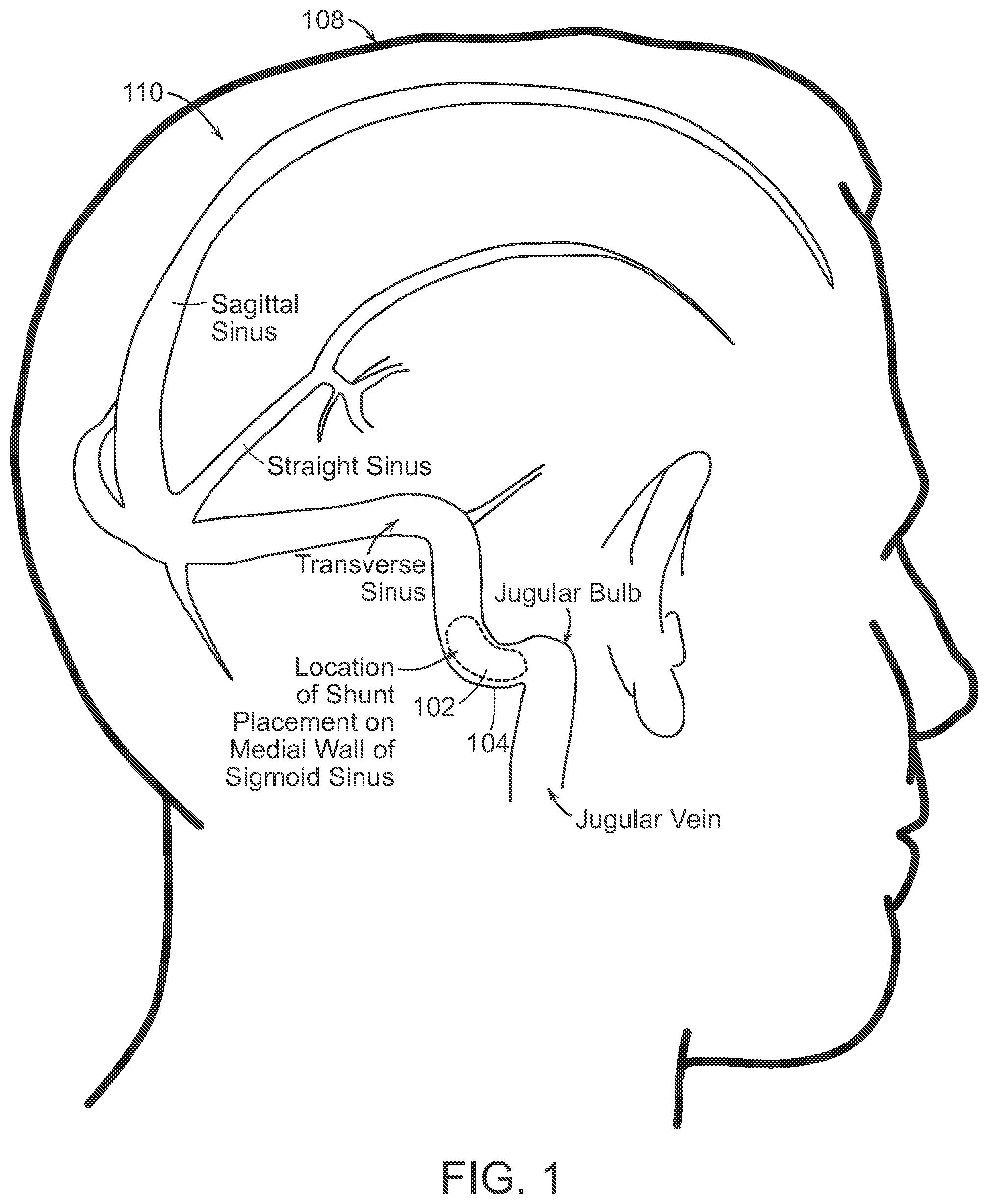 Patent US12090291 Figure 1 – Endovascular cerebrospinal fluid shunt