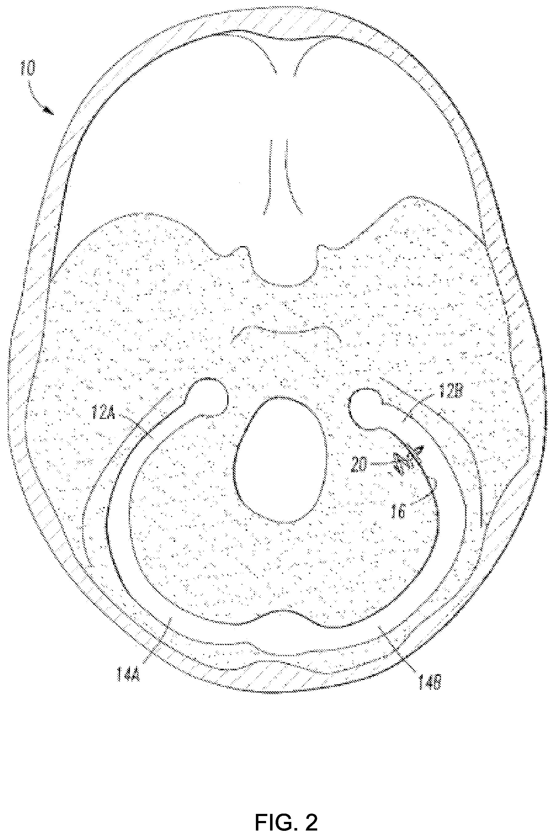 Patent US12090291 Figure 2 – Endovascular cerebrospinal fluid shunt