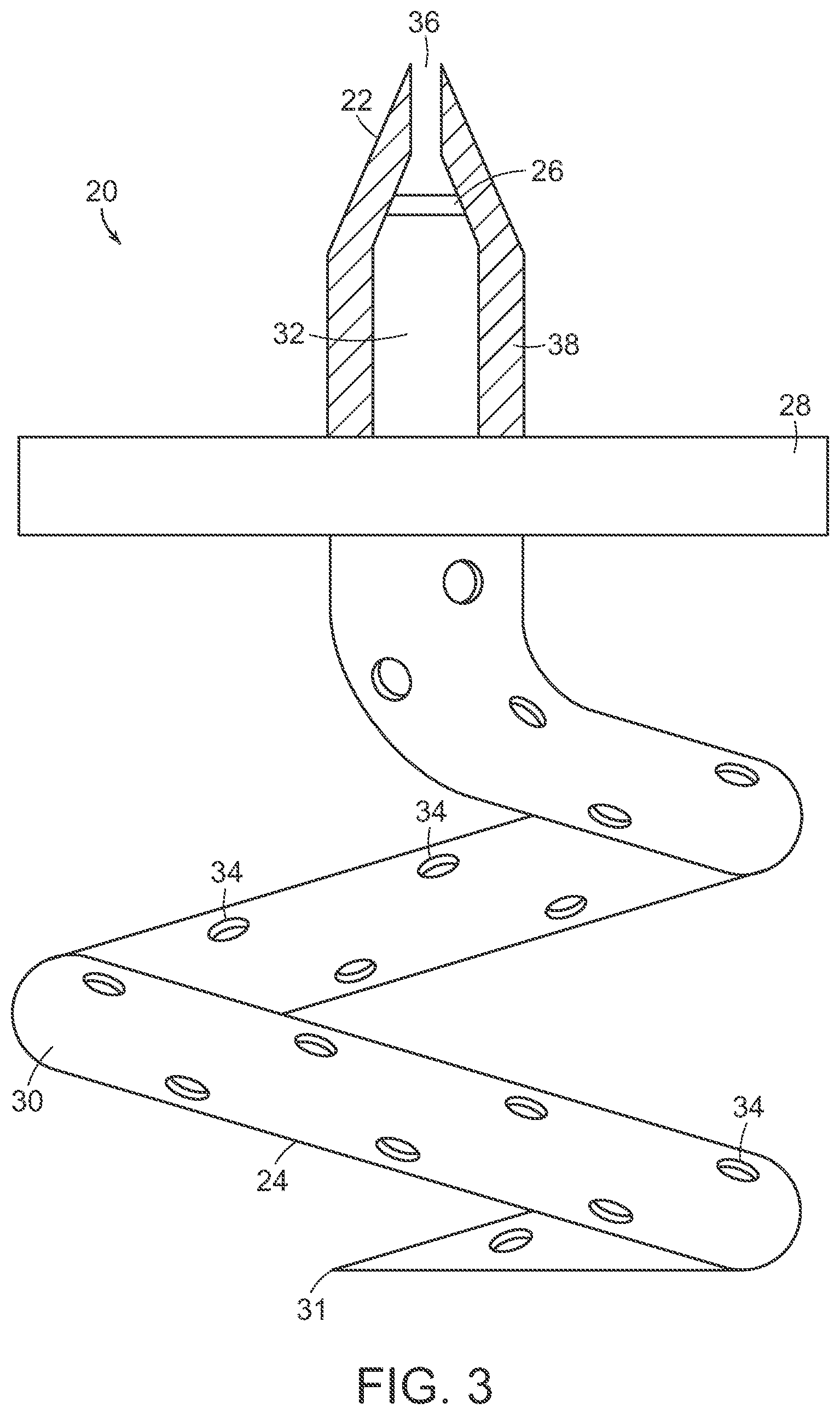 Patent US12090291 Figure 3 – Endovascular cerebrospinal fluid shunt
