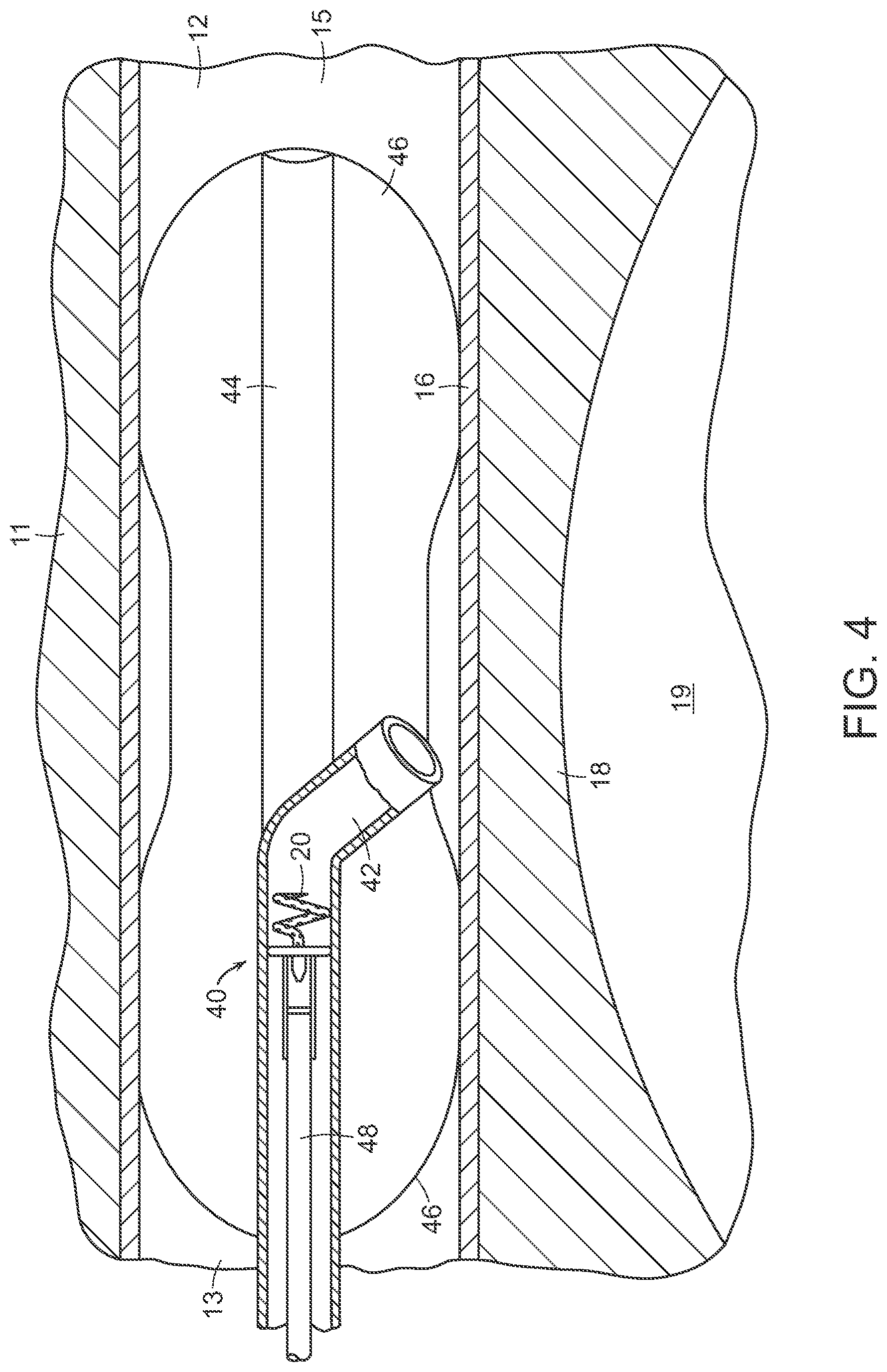 Patent US12090291 Figure 4 – Endovascular cerebrospinal fluid shunt