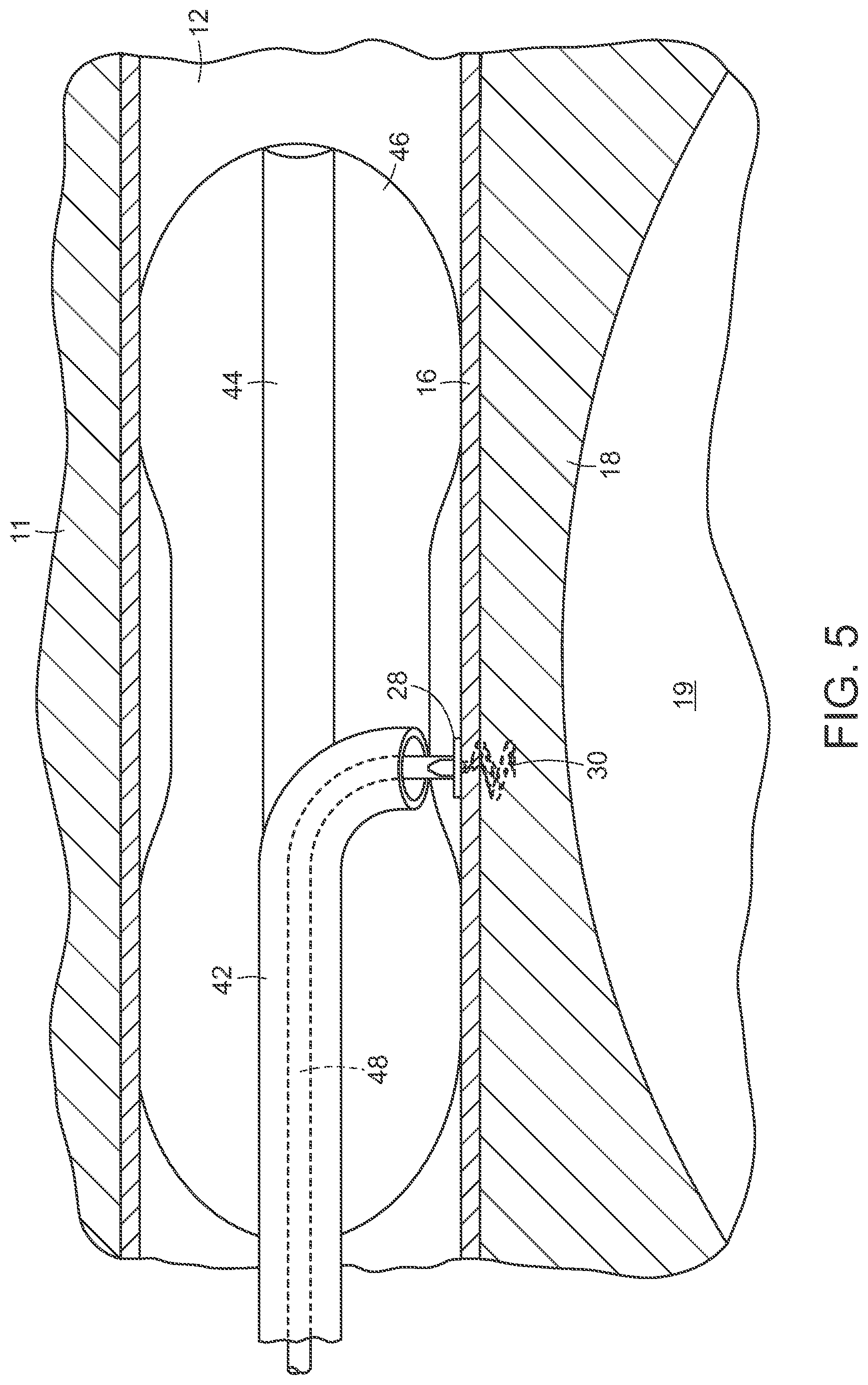 Patent US12090291 Figure 5 – Endovascular cerebrospinal fluid shunt