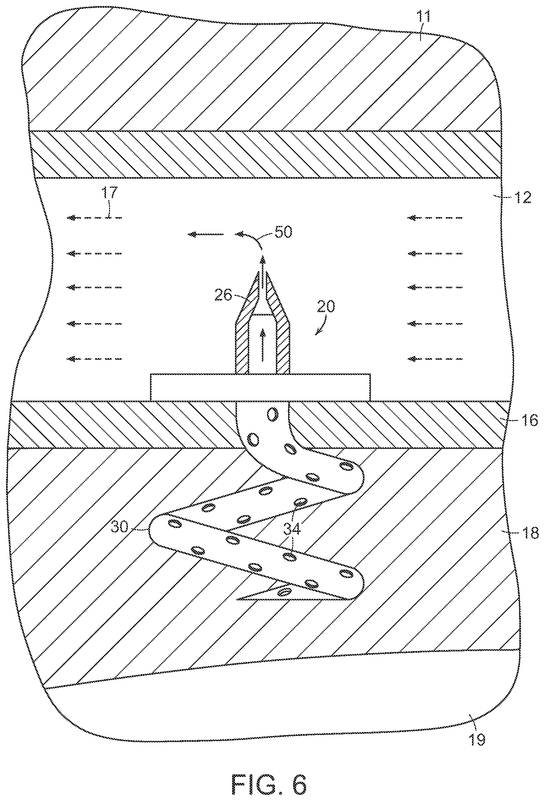 Patent US12090291 Figure 6 – Endovascular cerebrospinal fluid shunt