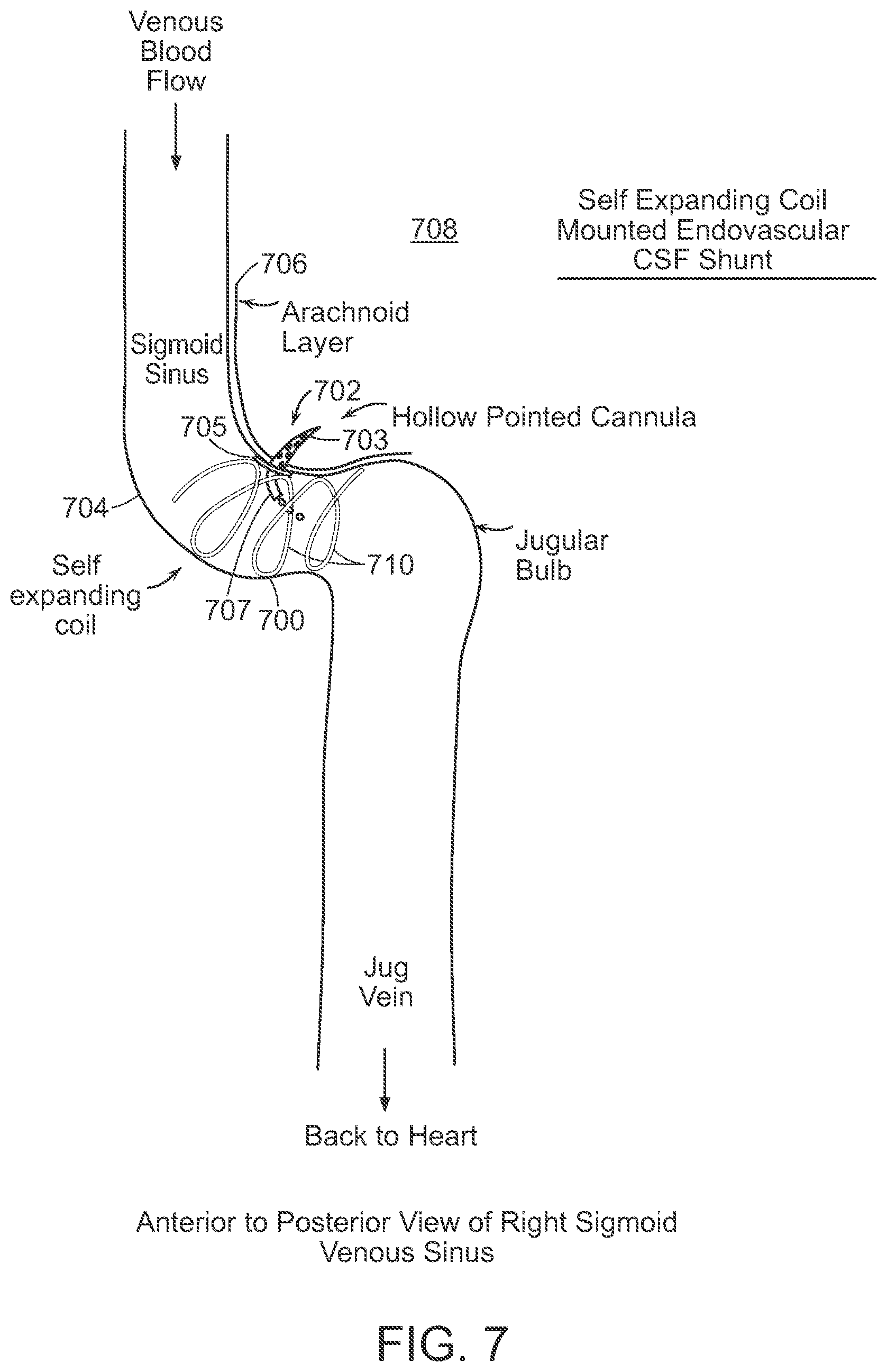 Patent US12090291 Figure 7 – Endovascular cerebrospinal fluid shunt