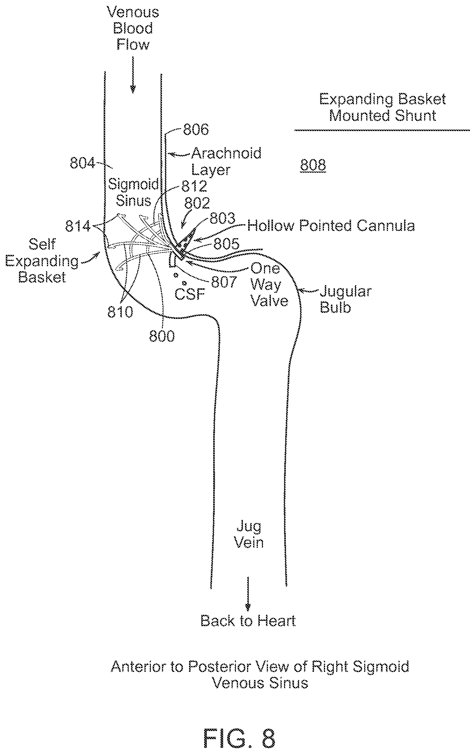 Patent US12090291 Figure 8 – Endovascular cerebrospinal fluid shunt
