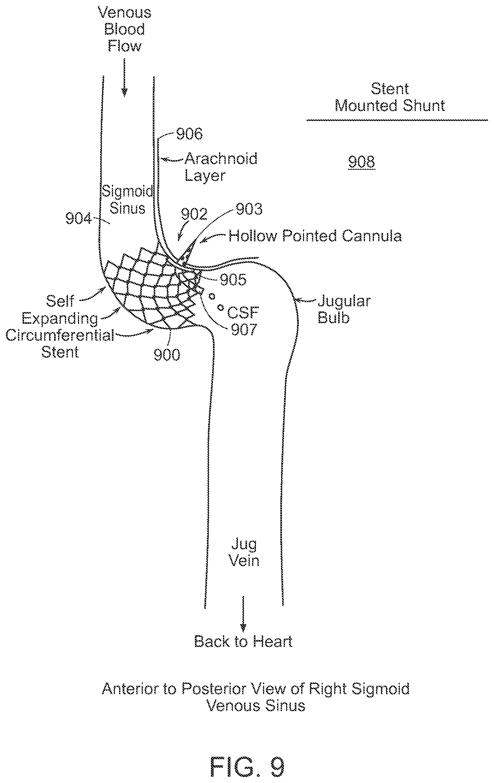 Patent US12090291 Figure 9 – Endovascular cerebrospinal fluid shunt