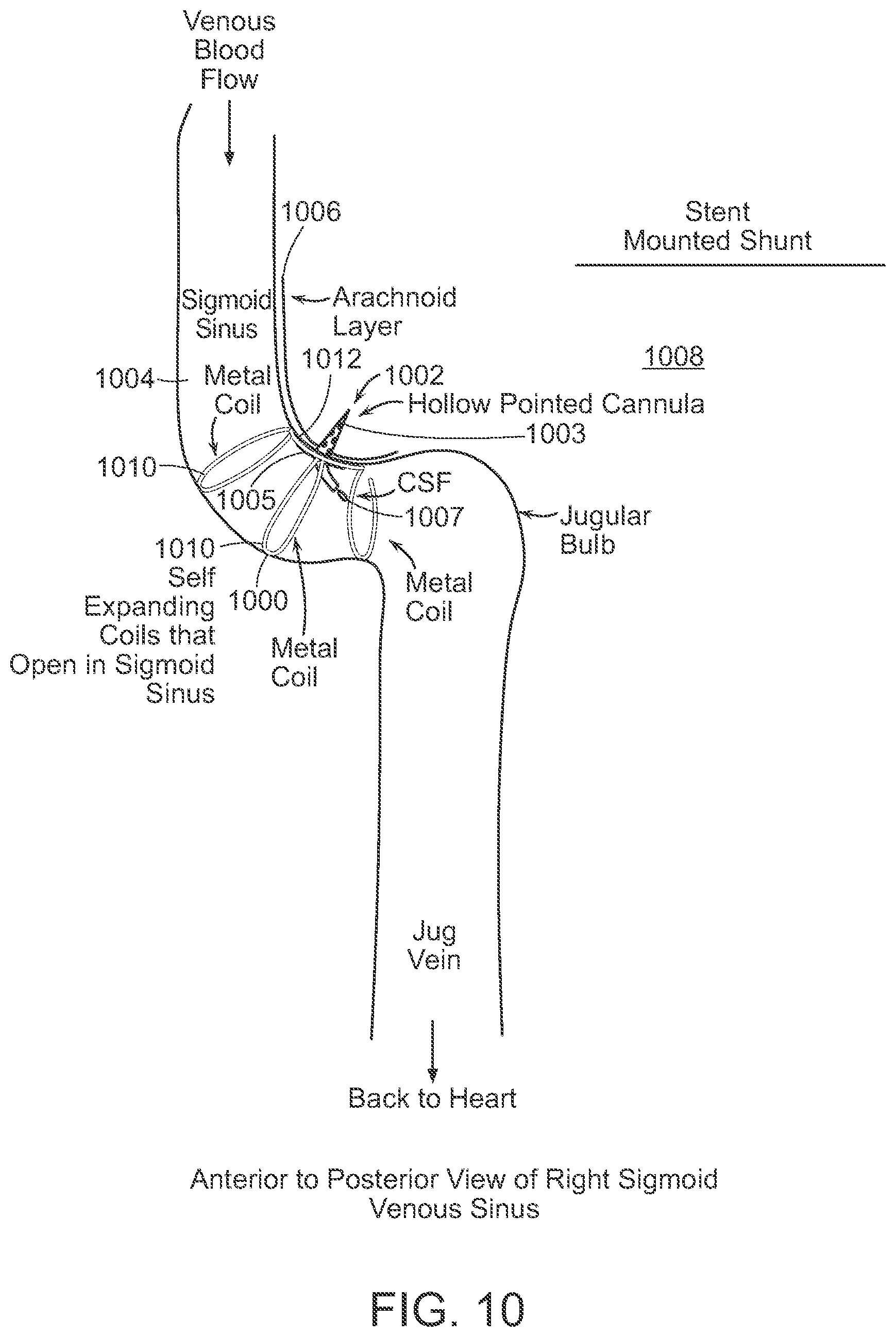 Patent US12090291 Figure 10 – Endovascular cerebrospinal fluid shunt