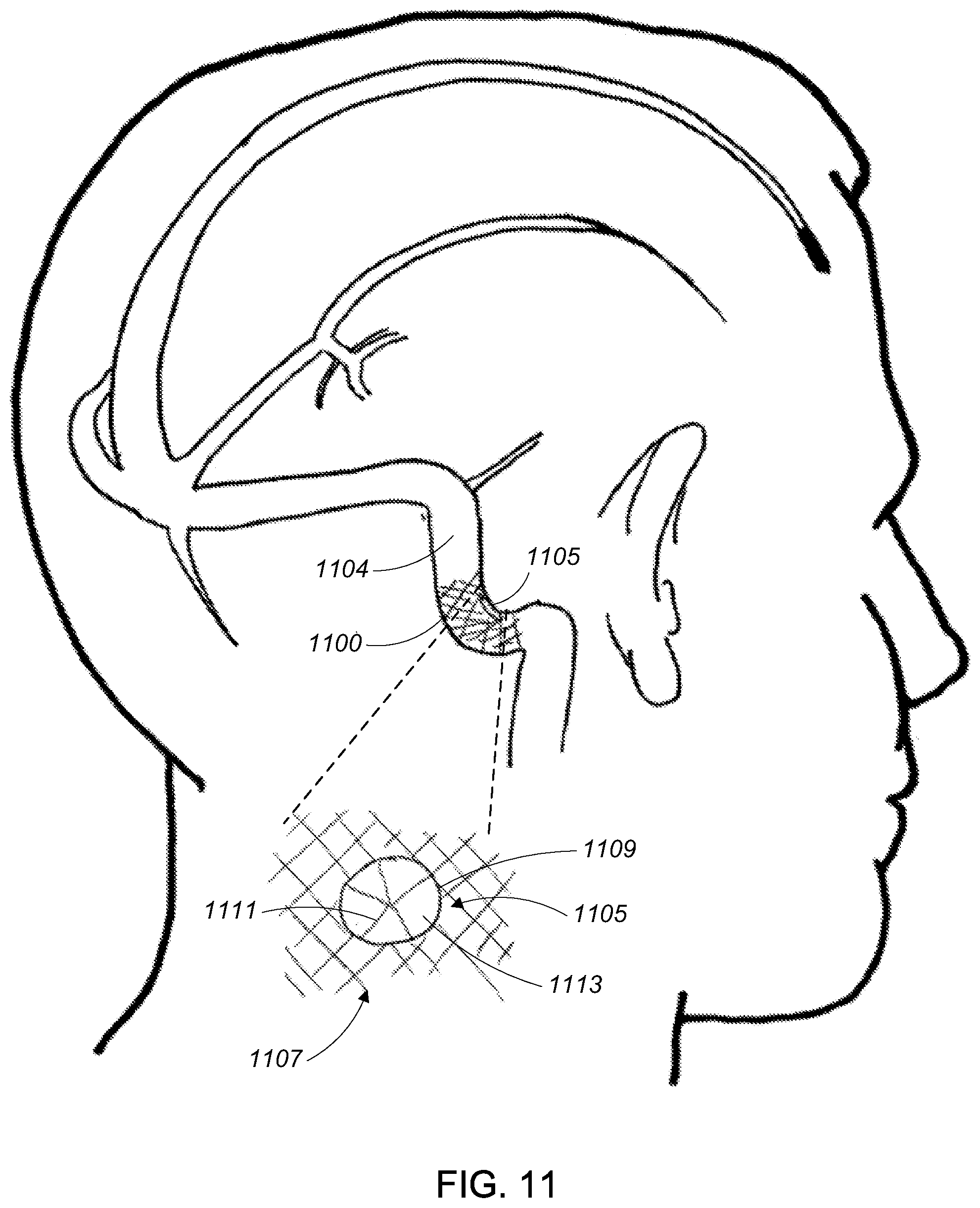 Patent US12090291 Figure 11 – Endovascular cerebrospinal fluid shunt