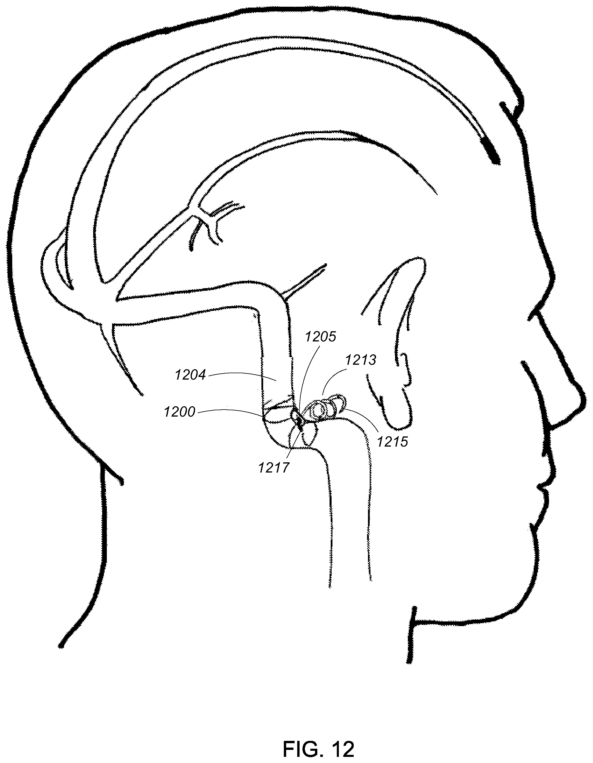 Patent US12090291 Figure 12 – Endovascular cerebrospinal fluid shunt