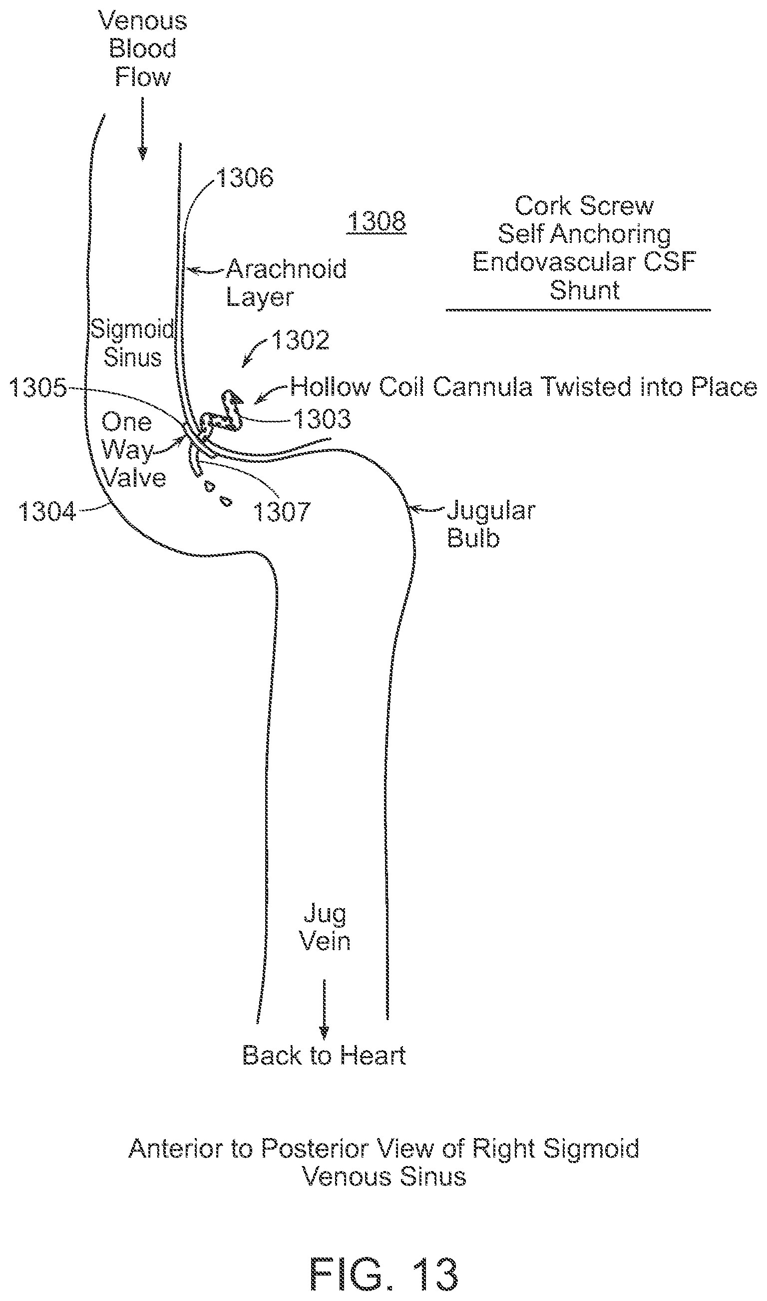 Patent US12090291 Figure 13 – Endovascular cerebrospinal fluid shunt