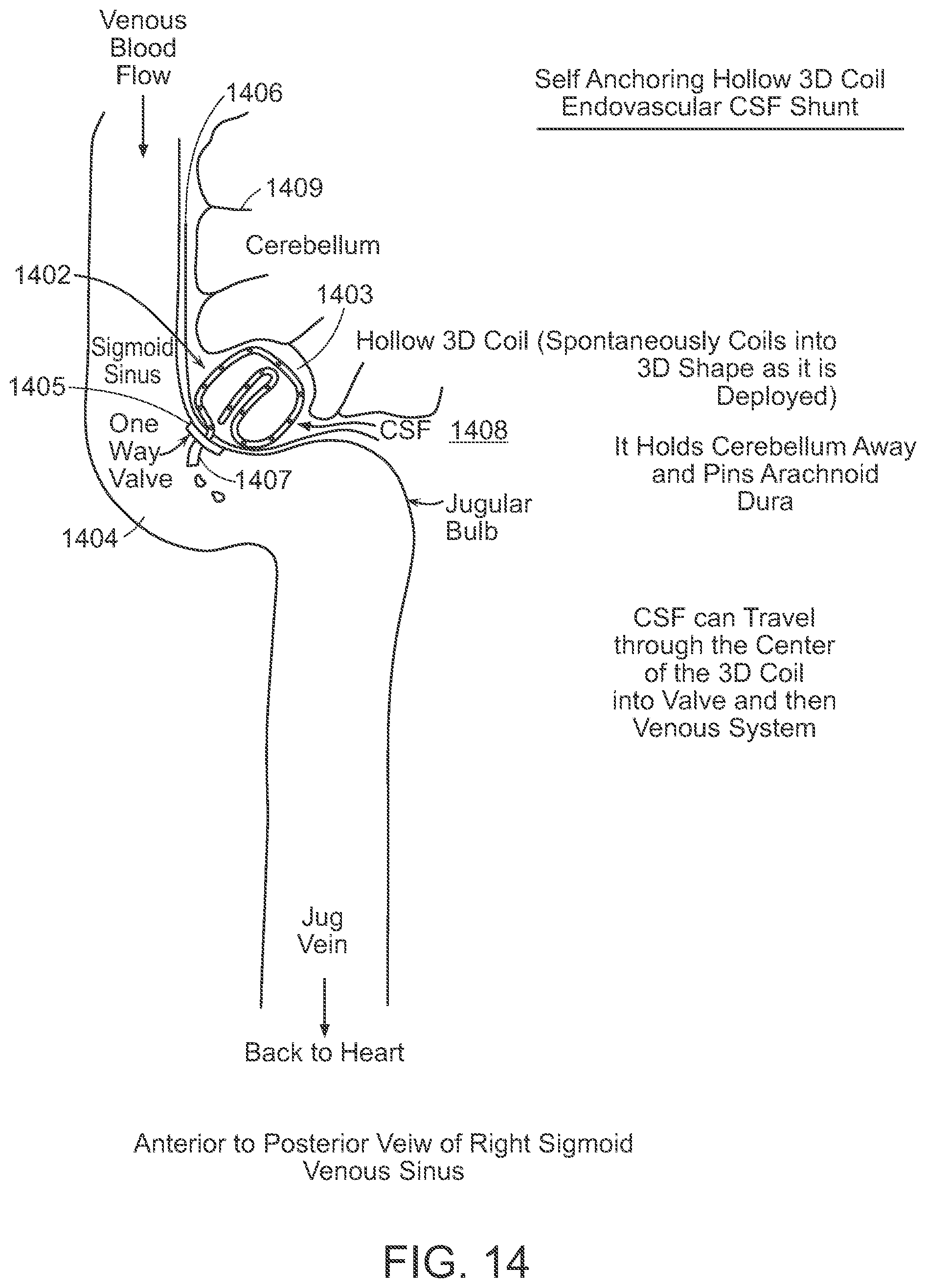 Patent US12090291 Figure 14 – Endovascular cerebrospinal fluid shunt