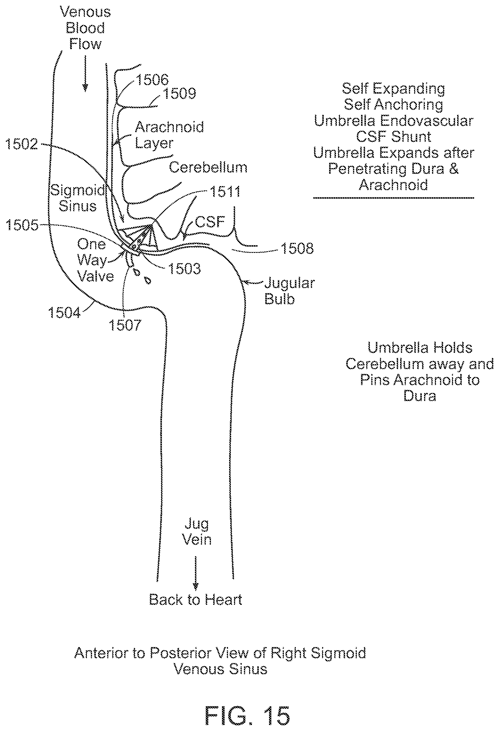 Patent US12090291 Figure 15 – Endovascular cerebrospinal fluid shunt