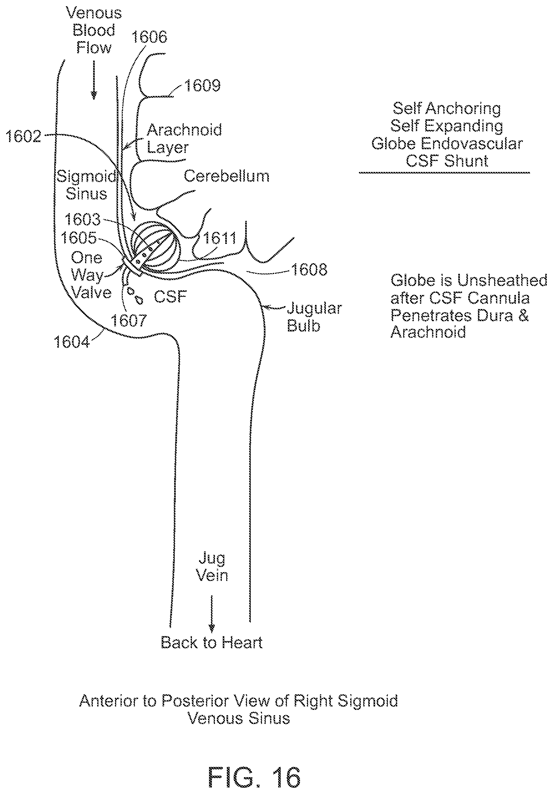 Patent US12090291 Figure 16 – Endovascular cerebrospinal fluid shunt