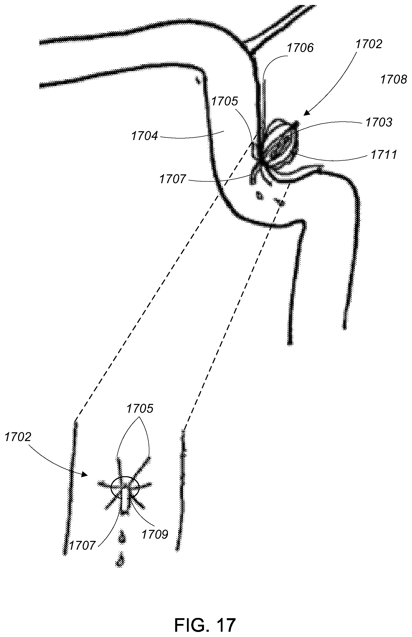 Patent US12090291 Figure 17 – Endovascular cerebrospinal fluid shunt