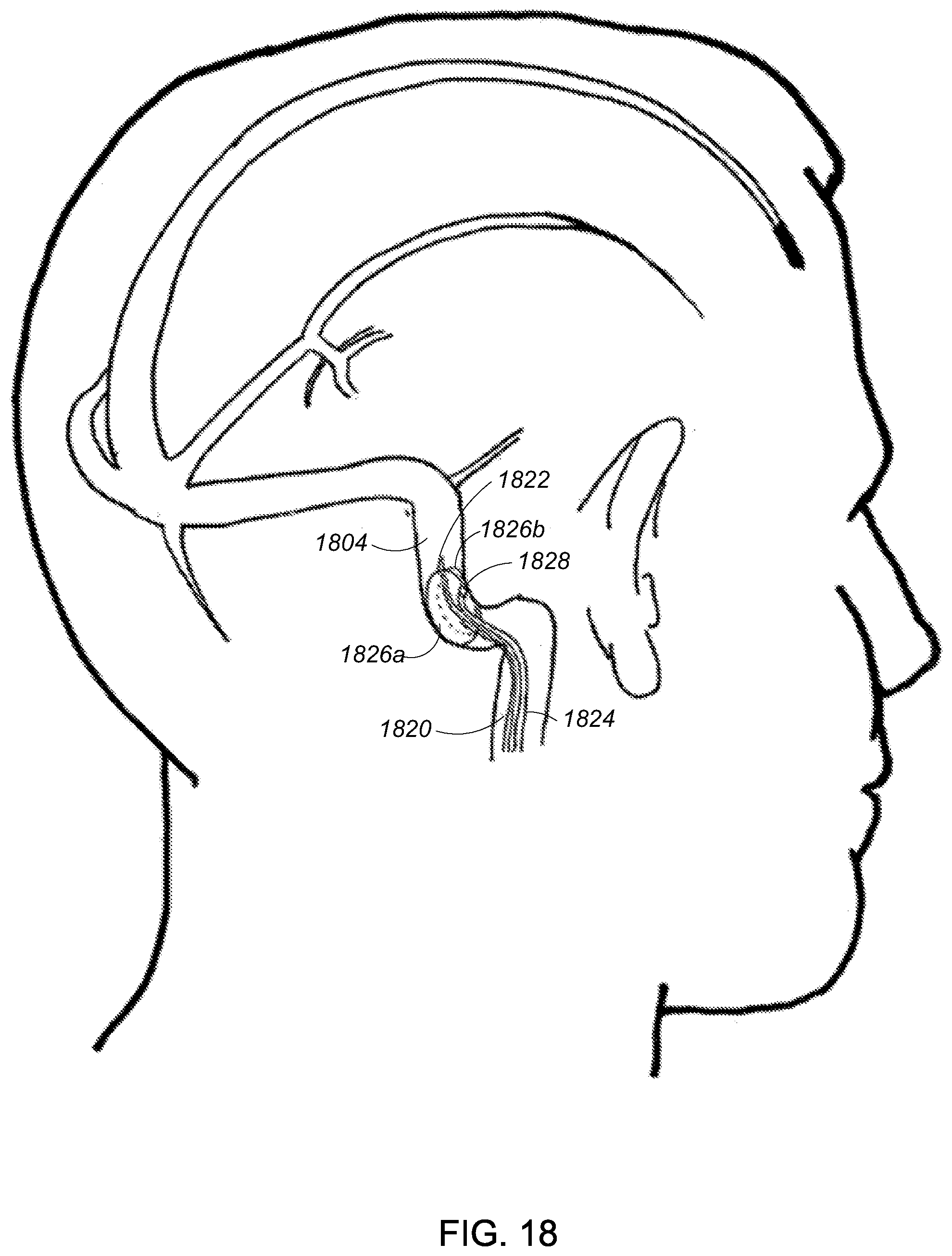 Patent US12090291 Figure 18 – Endovascular cerebrospinal fluid shunt