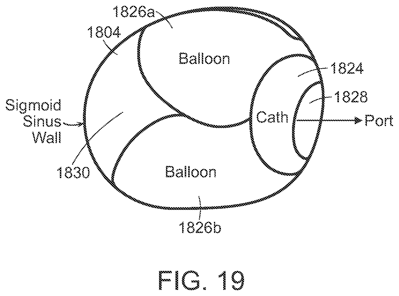 Patent US12090291 Figure 19 – Endovascular cerebrospinal fluid shunt