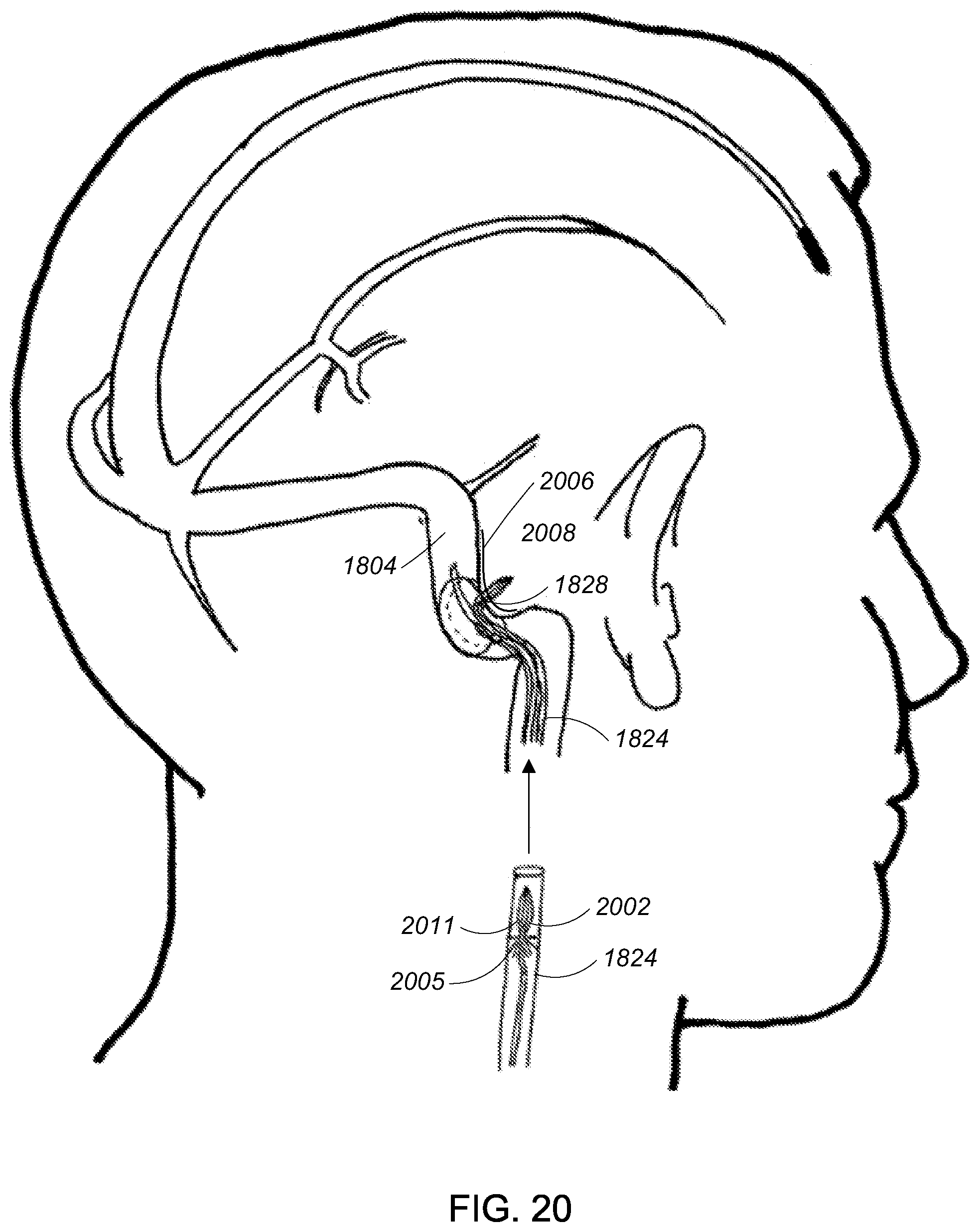 Patent US12090291 Figure 20 – Endovascular cerebrospinal fluid shunt