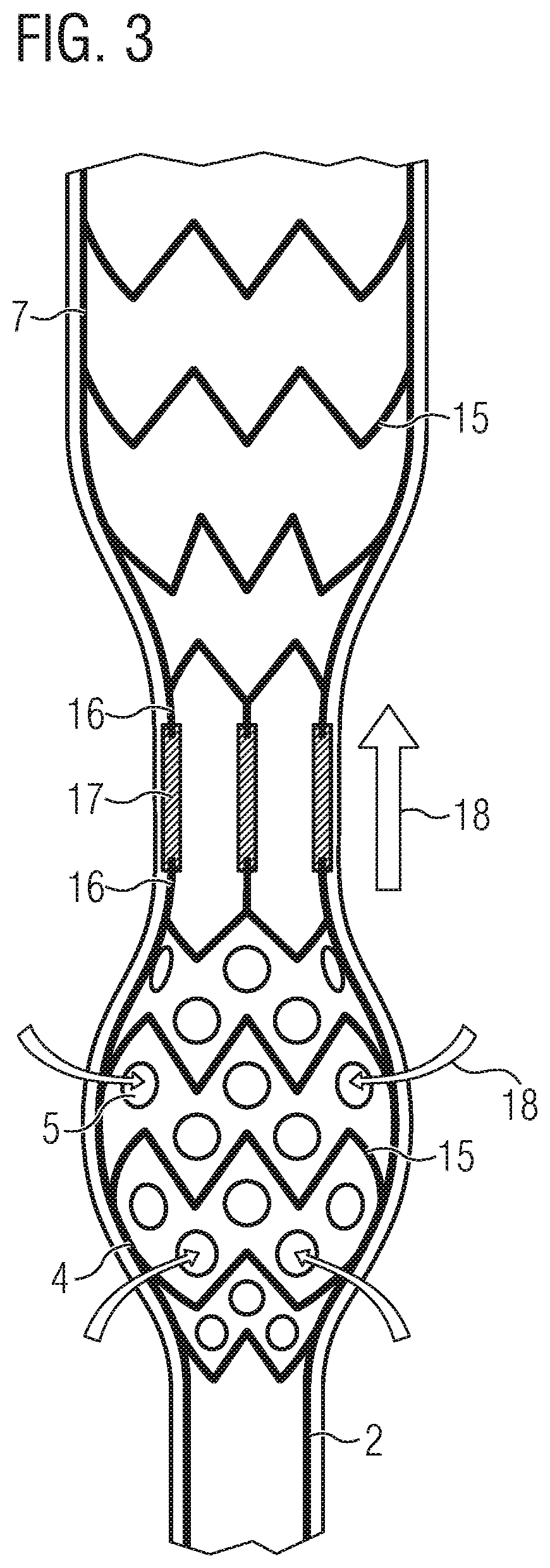 Patent US12090311 Figure 3 – Pump catheter for the directed pulsatile conveying of blood