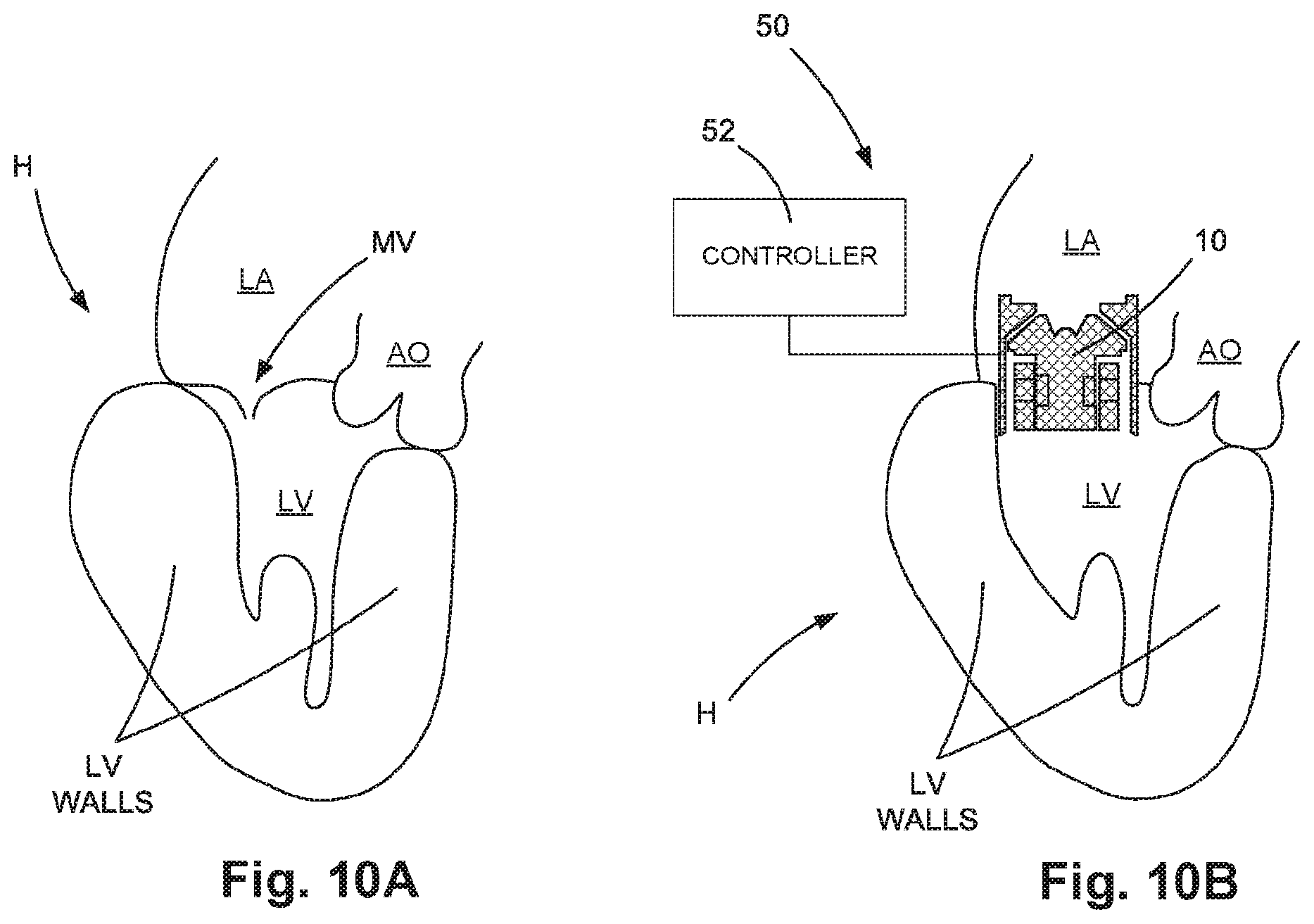 Patent US12090312 Figure 4 – Atrial assist device