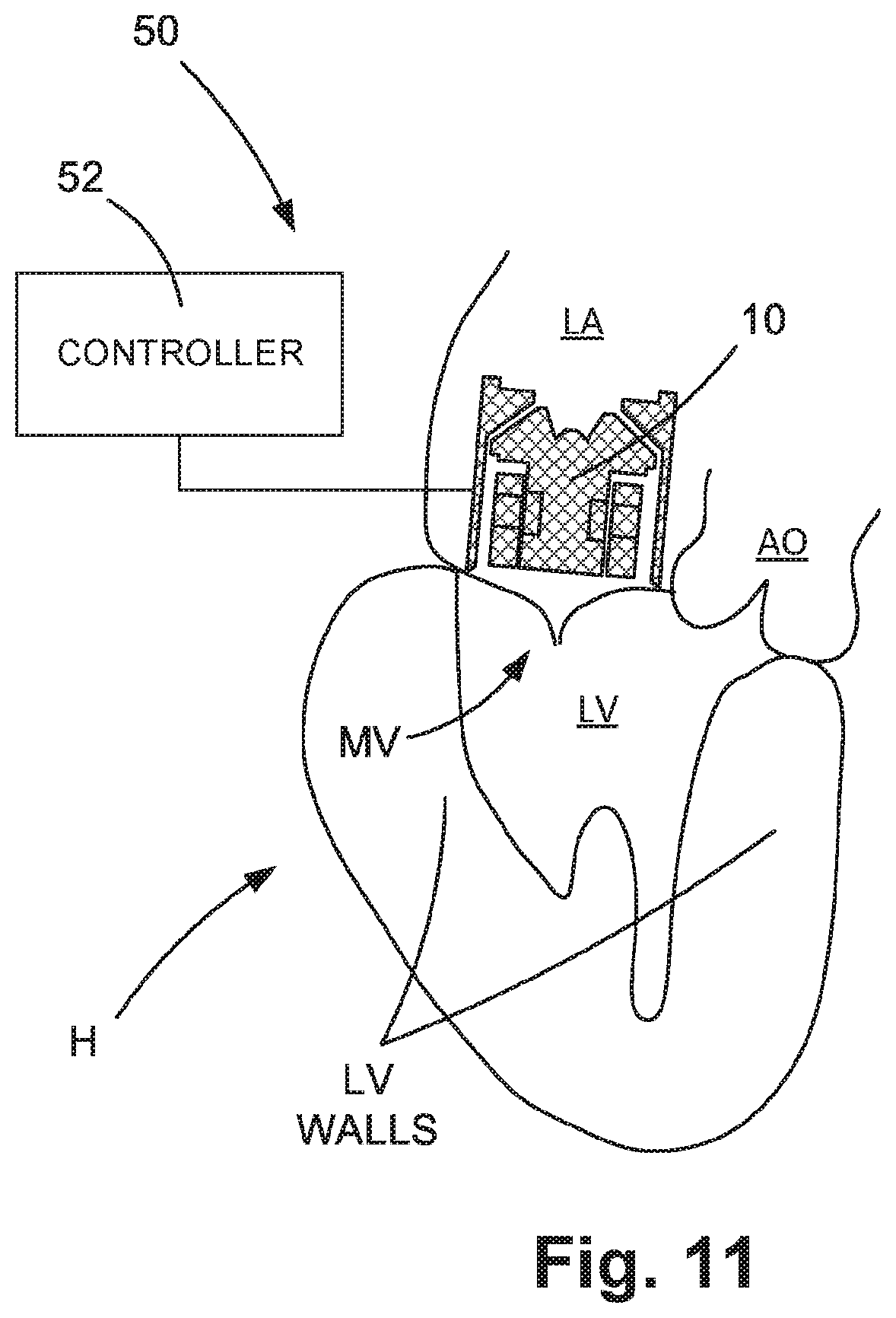 Patent US12090312 Figure 5 – Atrial assist device
