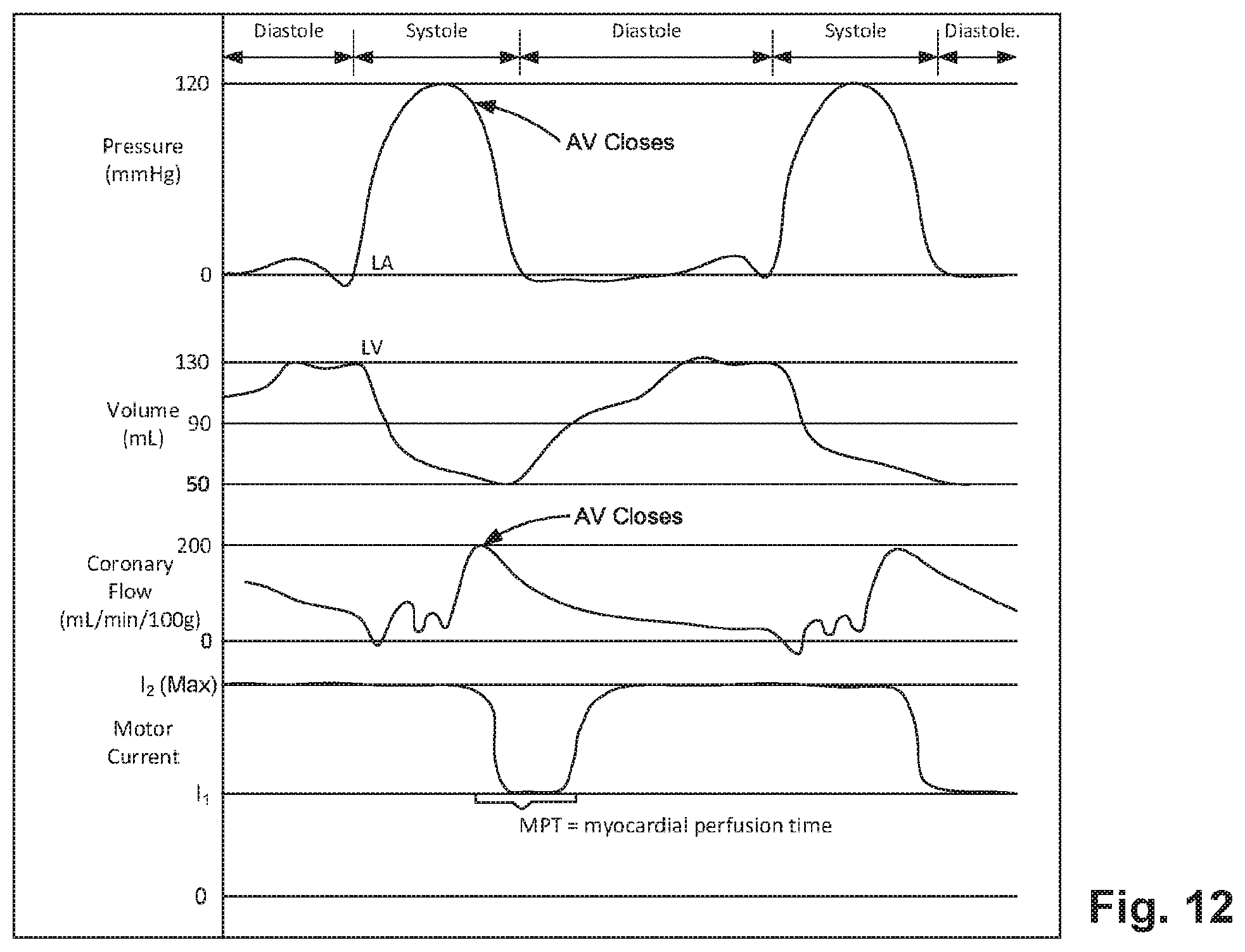 Patent US12090312 Figure 6 – Atrial assist device
