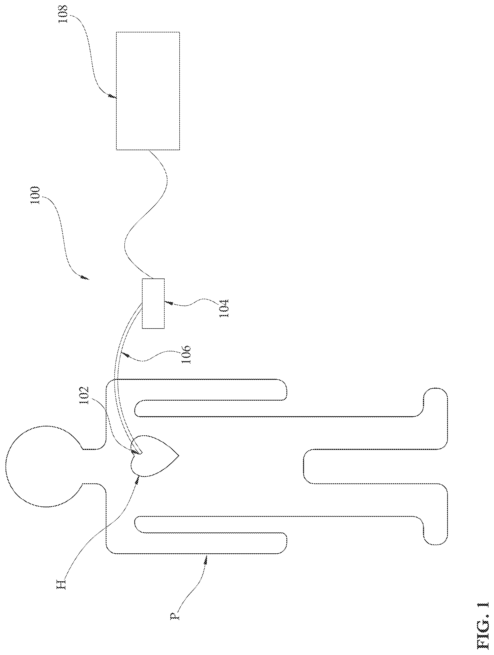 Patent US12090313 Figure 1 – Expandable mechanical hemodynamic support systems, devices, and methods