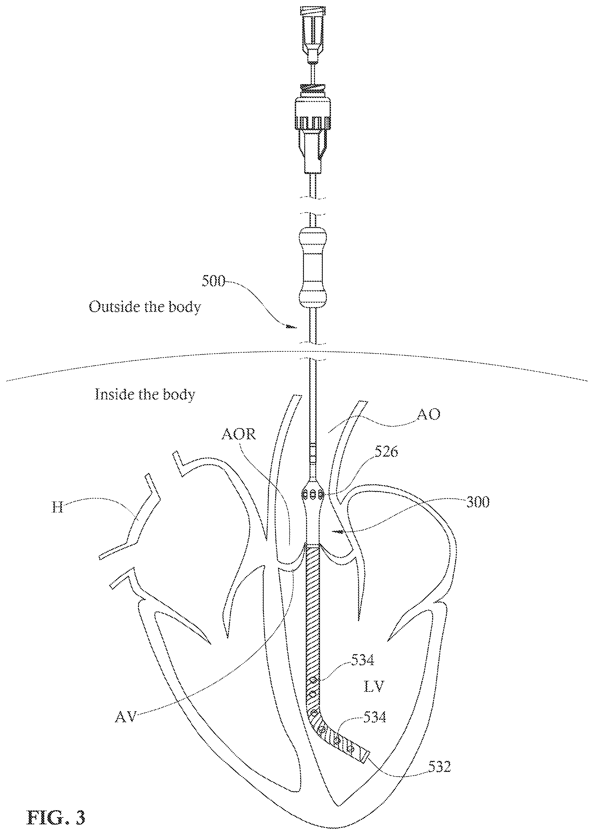 Patent US12090313 Figure 3 – Expandable mechanical hemodynamic support systems, devices, and methods