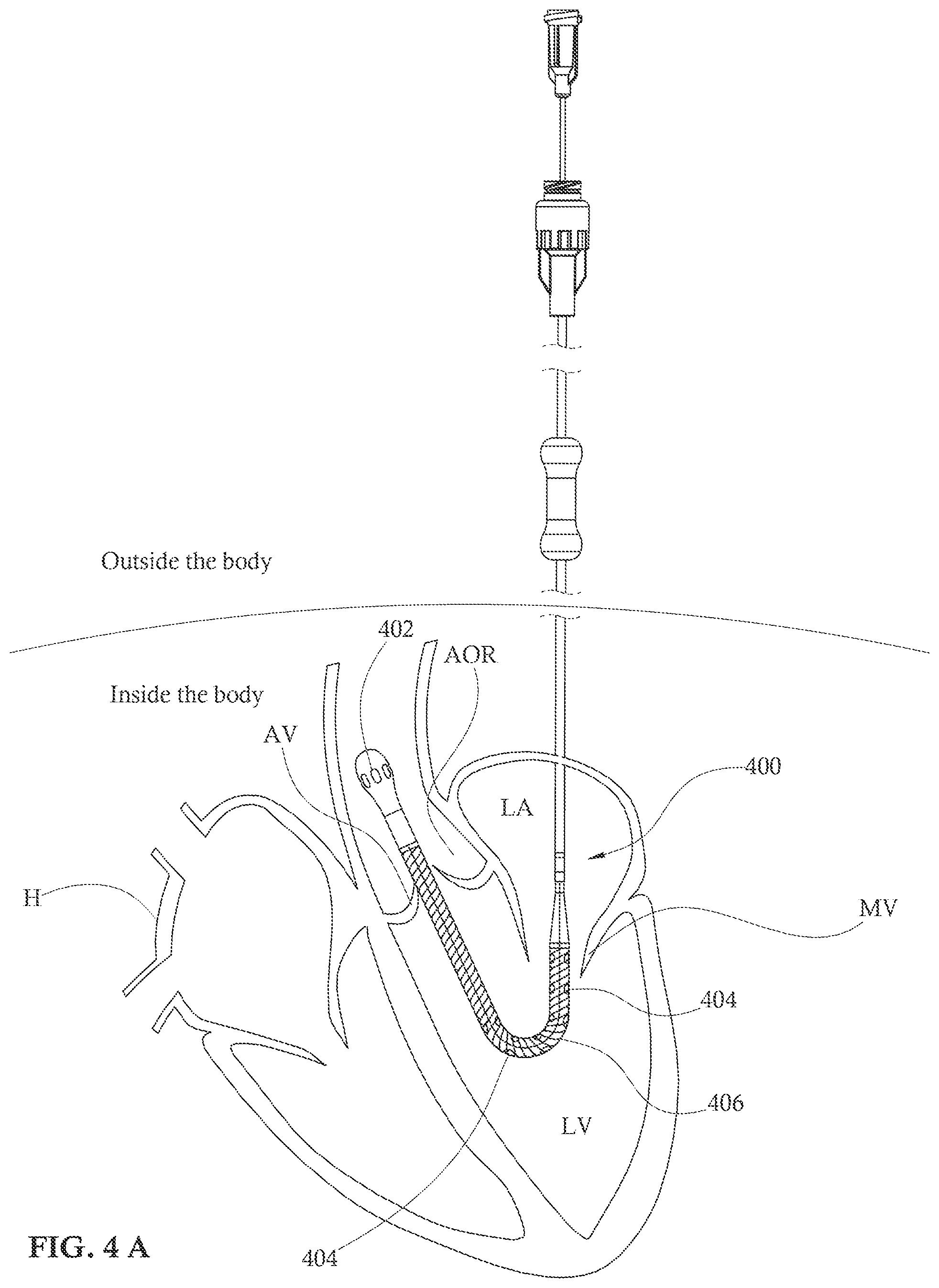 Patent US12090313 Figure 4 – Expandable mechanical hemodynamic support systems, devices, and methods