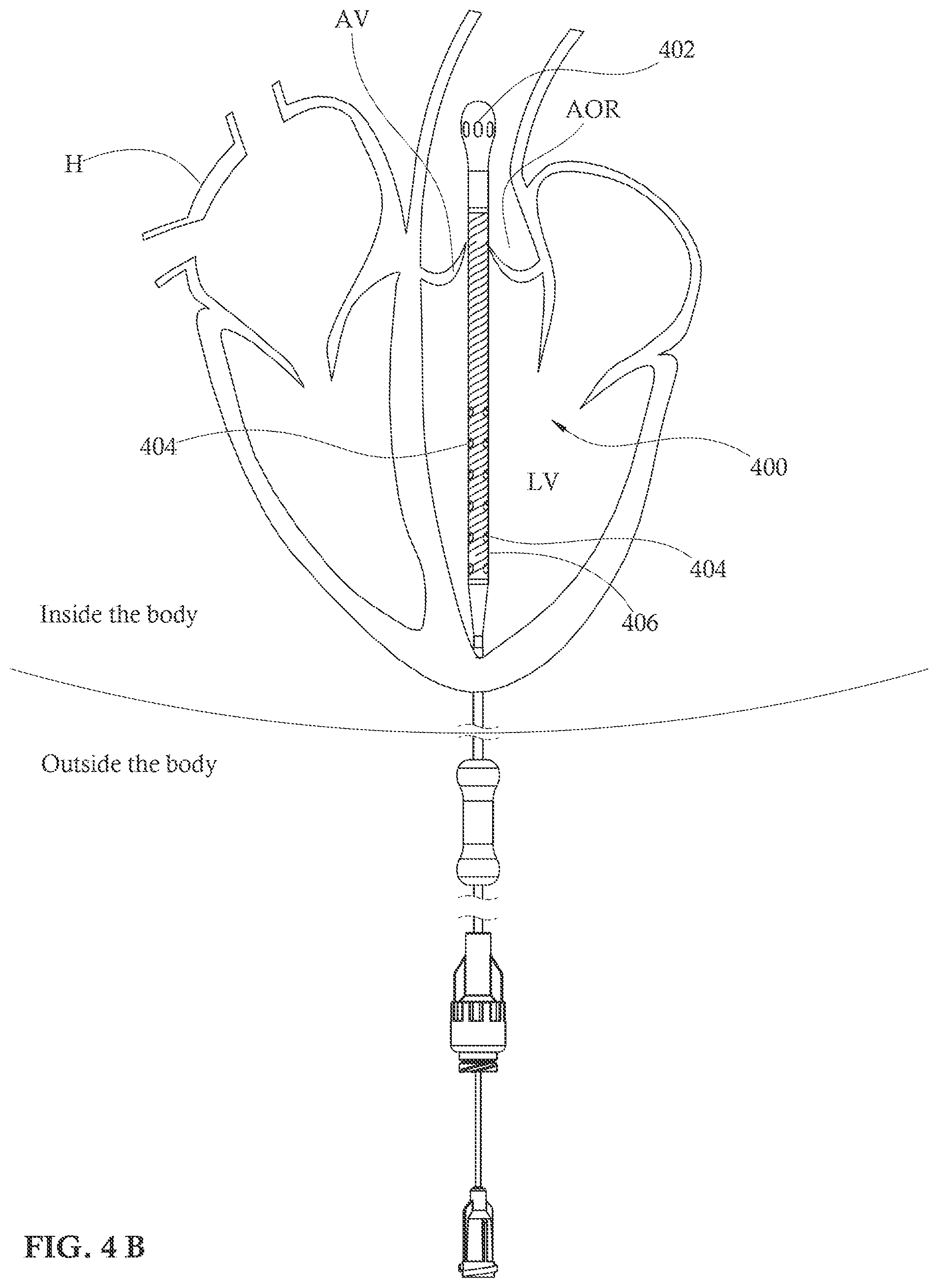 Patent US12090313 Figure 5 – Expandable mechanical hemodynamic support systems, devices, and methods