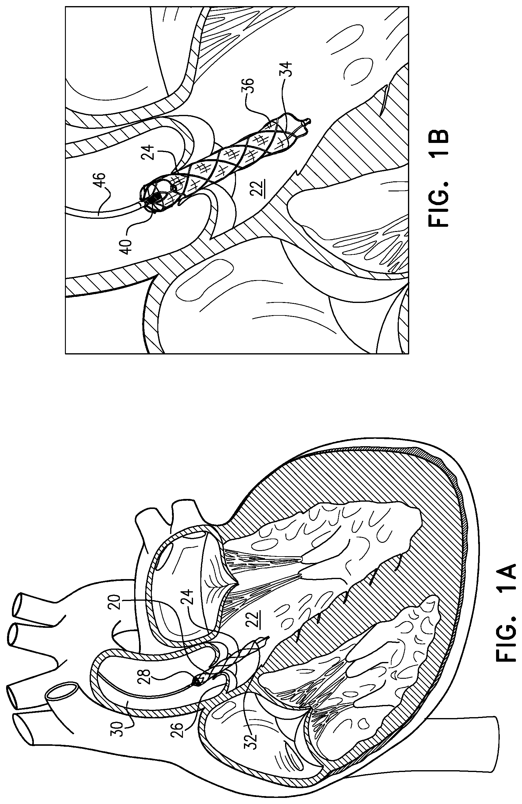 Patent US12090314 Figure 1 – Ventricular assist device